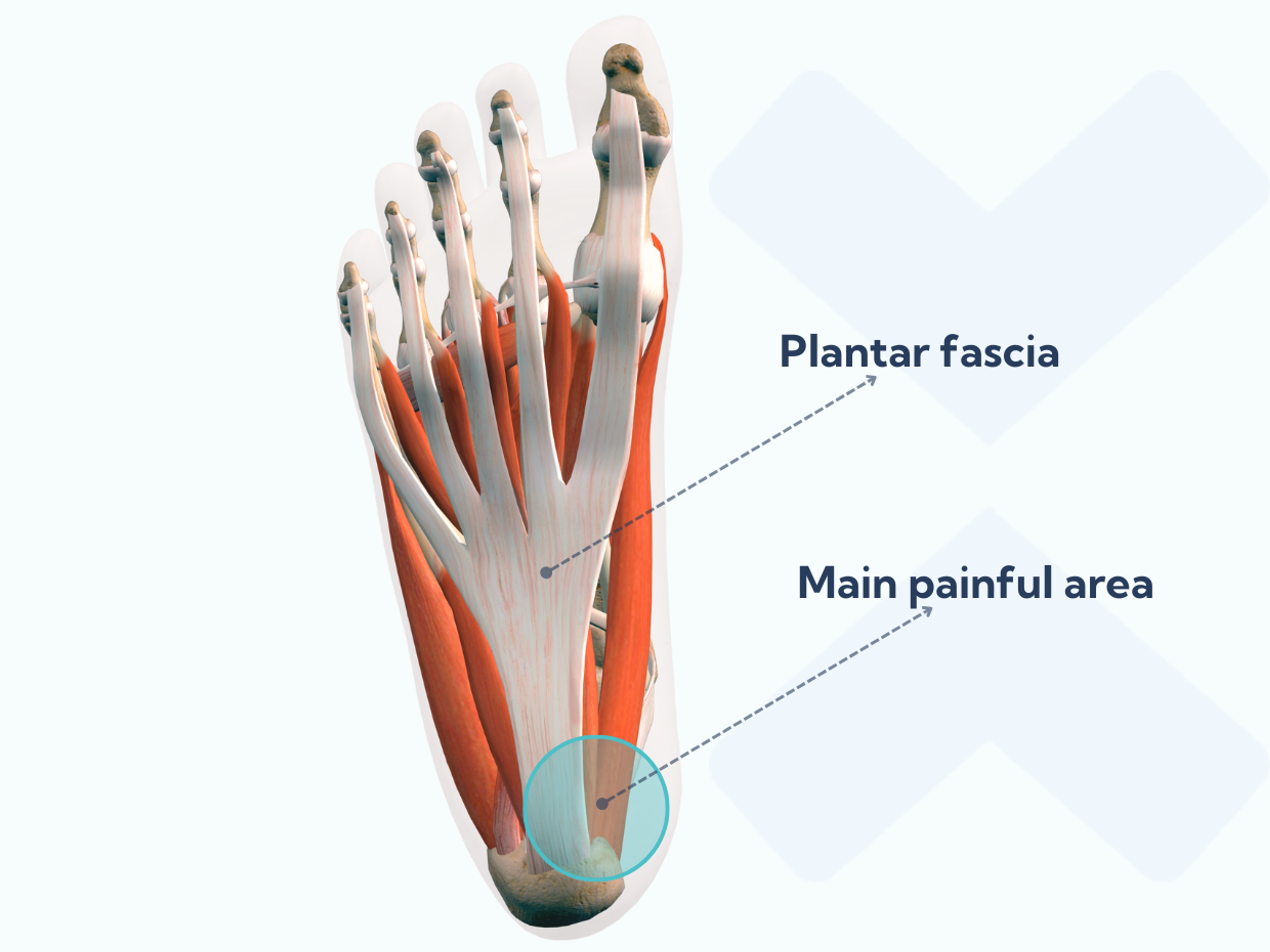 Anatomy picture of the plantar fascia and where you feel the pain when you have plantar fasciitis.