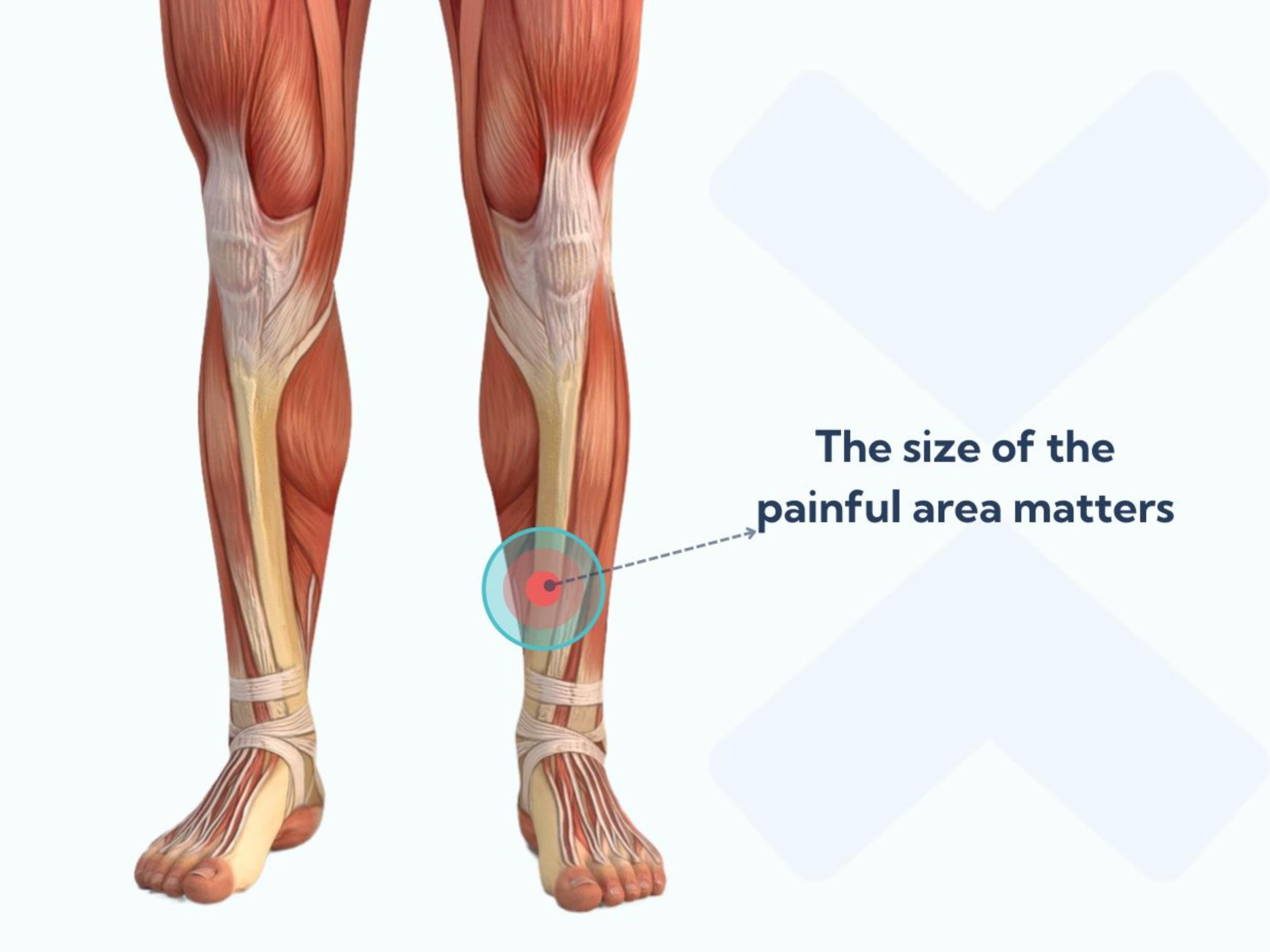 If your inner shin pain is concentrated in a small area (fewer than 10cm long) it may not be shin splints. You may have a stress fracture instead.