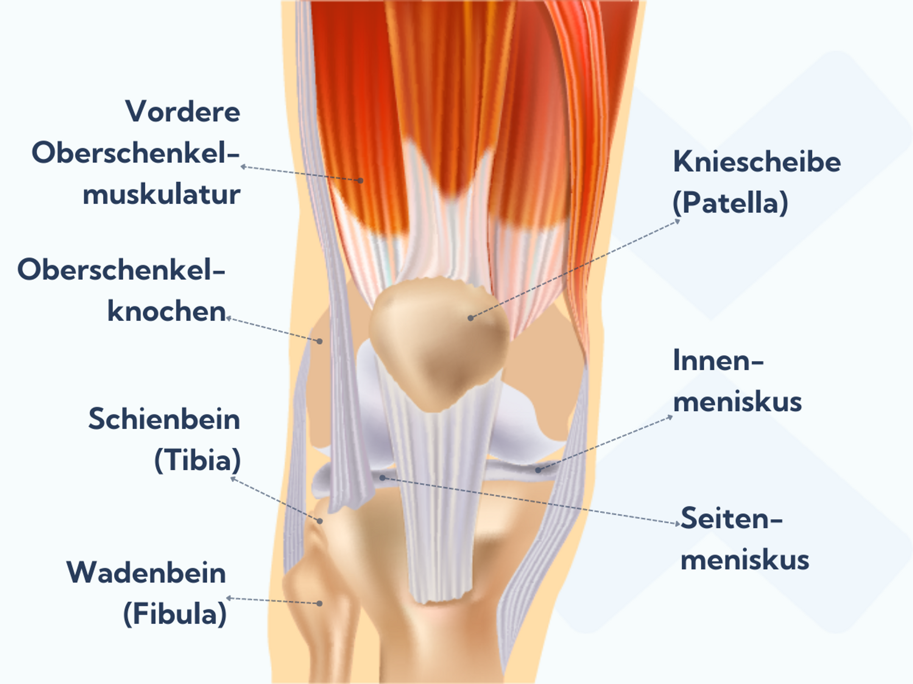 Ein verstauchtes Knie schwillt nur an, wenn Gewebe im Inneren des Kniegelenks verletzt wurde. Wir zeigen dir, wie du ein geschwollenes Knie behandeln kannst und ein paar Übungen für verstauchte Knie.