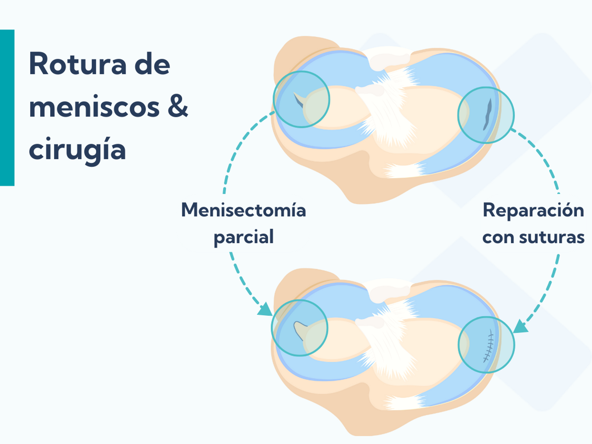 Roturas de meniscos: Causas, síntomas y tratamiento