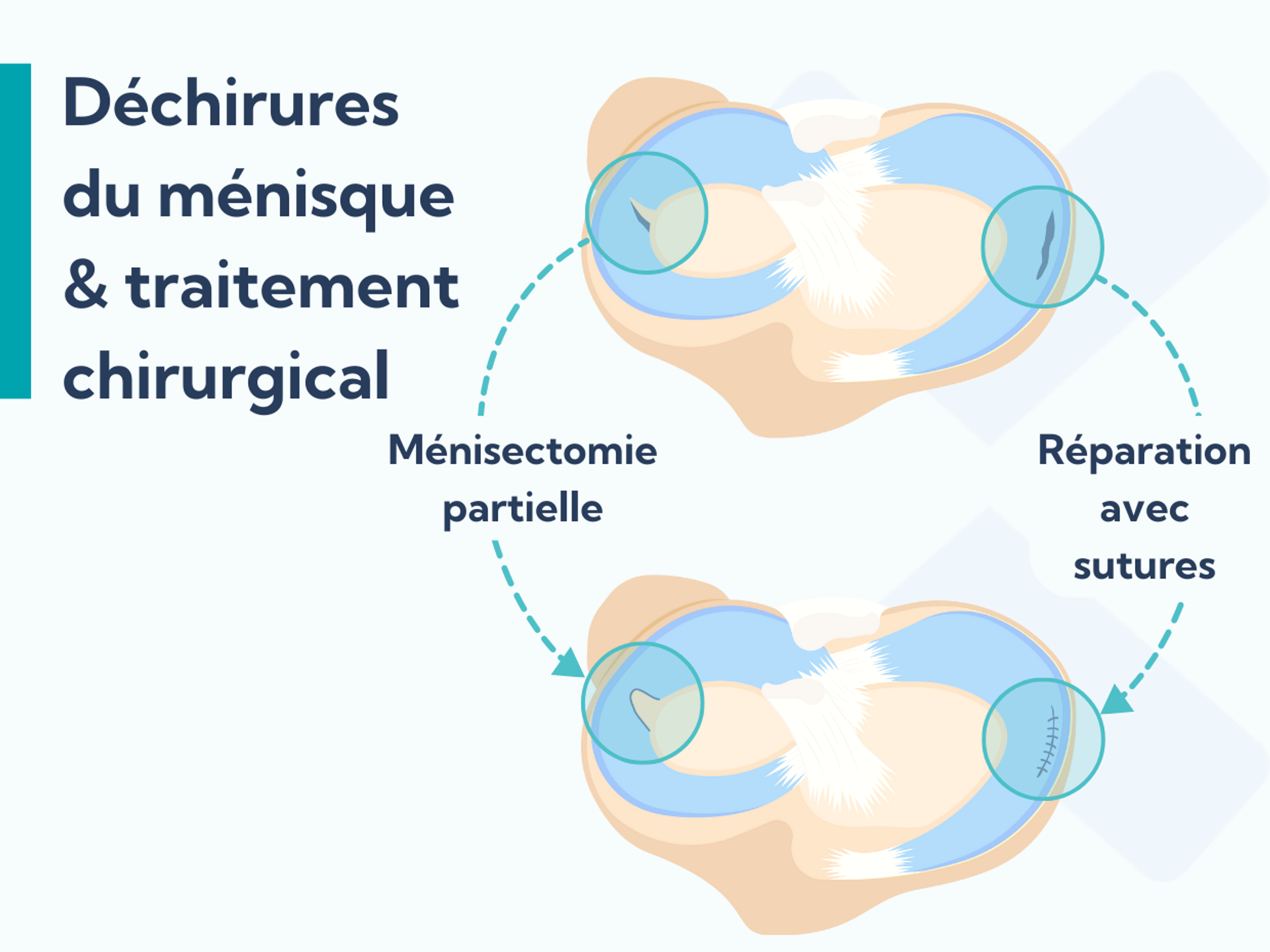 Fissure du ménisque symptômes, causes et traitement