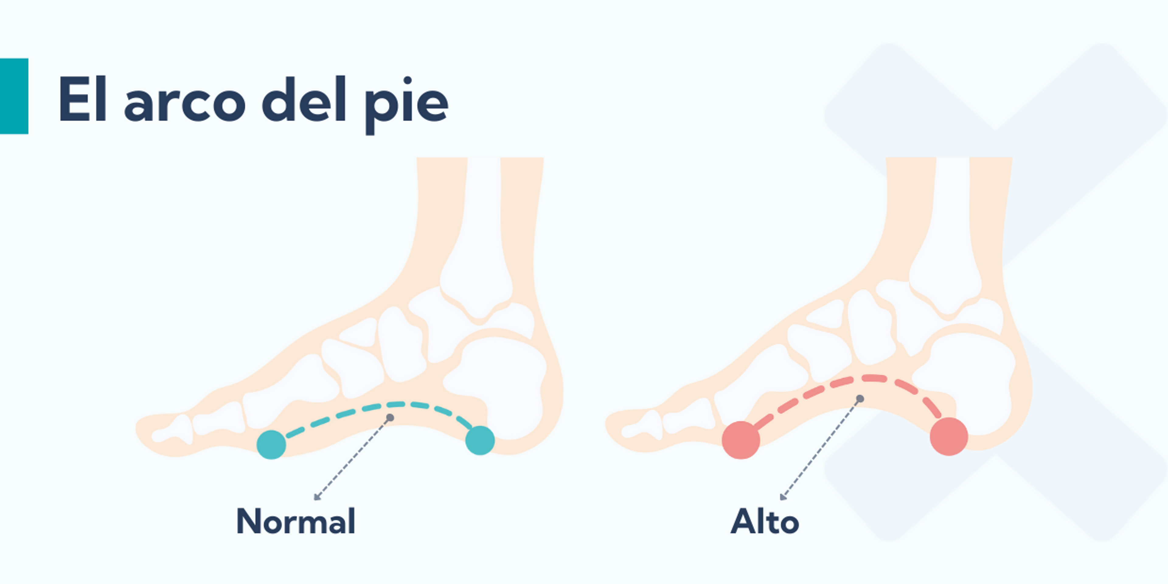 Tener un pie cavo puede ser la causa de sufrir una periostitis tibial