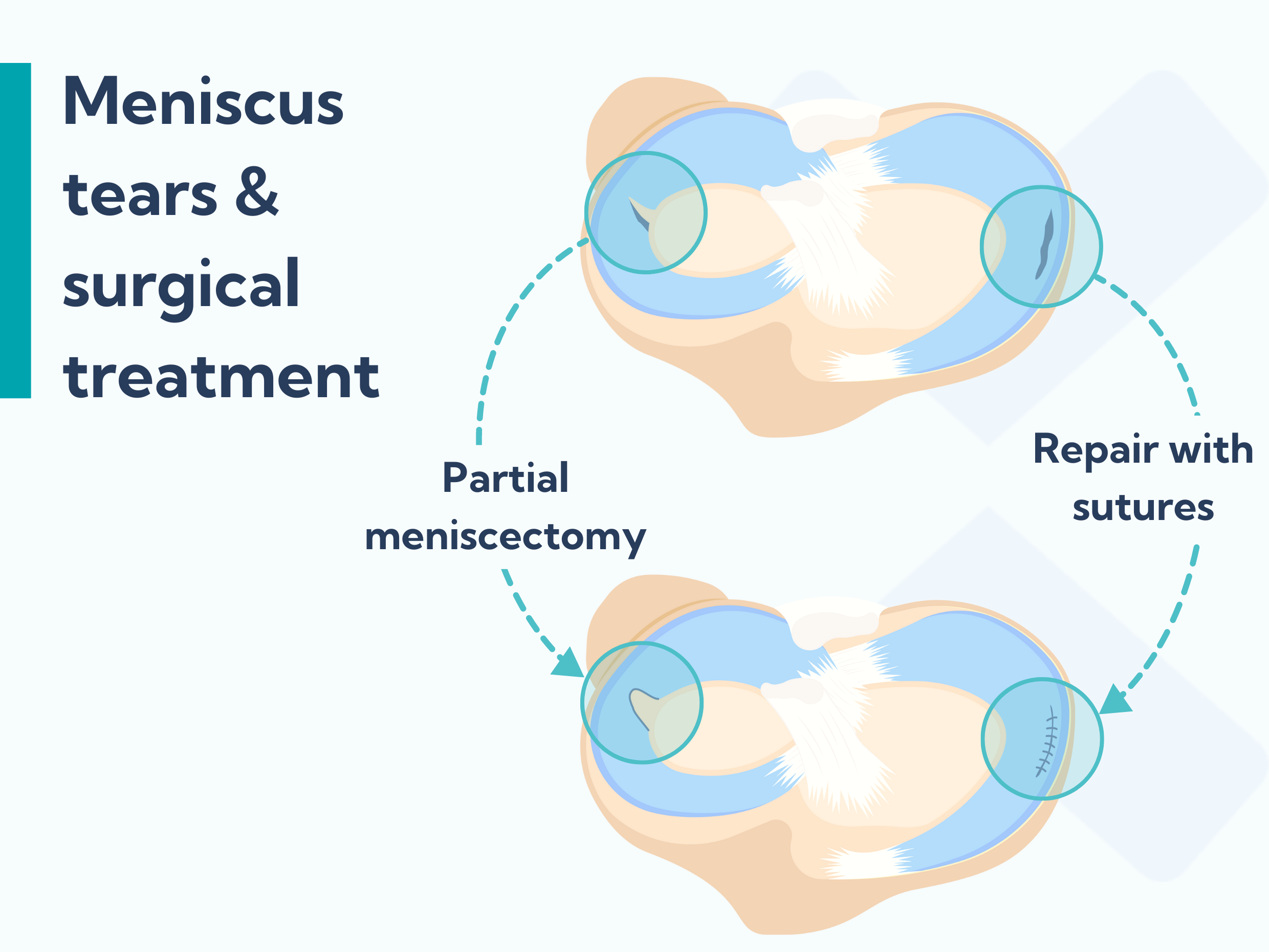 An Overview Of Meniscus Tears: Causes, Symptoms, Diagnosis, And ...