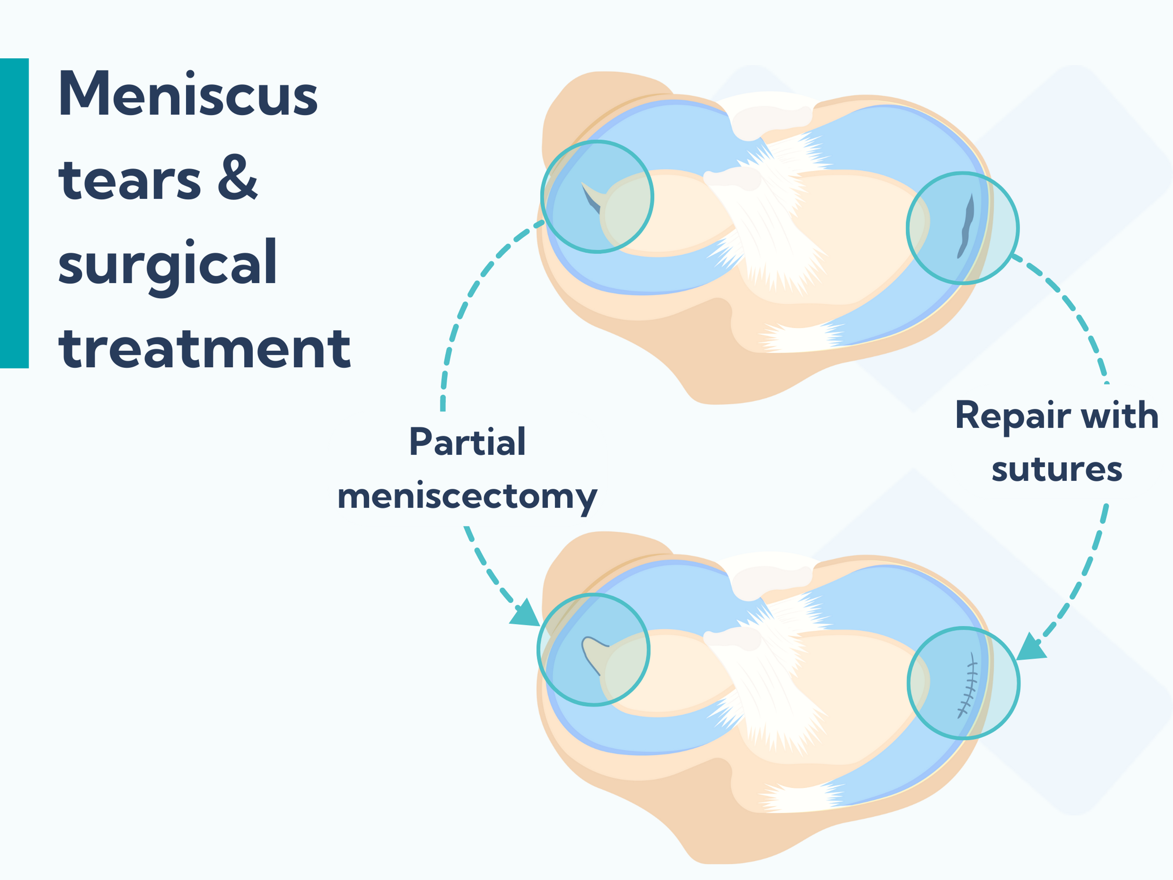 A meniscus tear can either be repaired or trimmed.