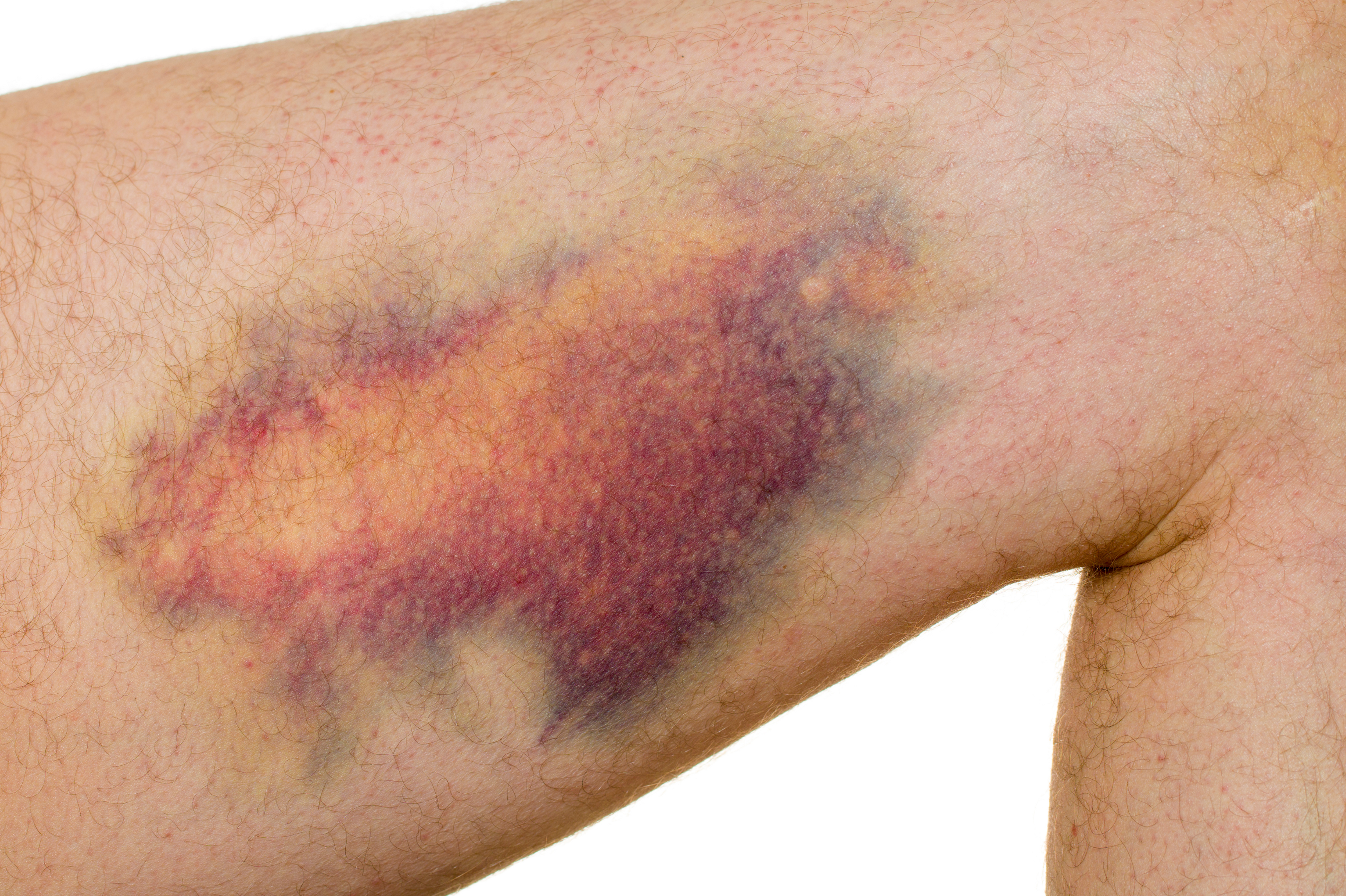 Bruises change color as the body absorbs them.