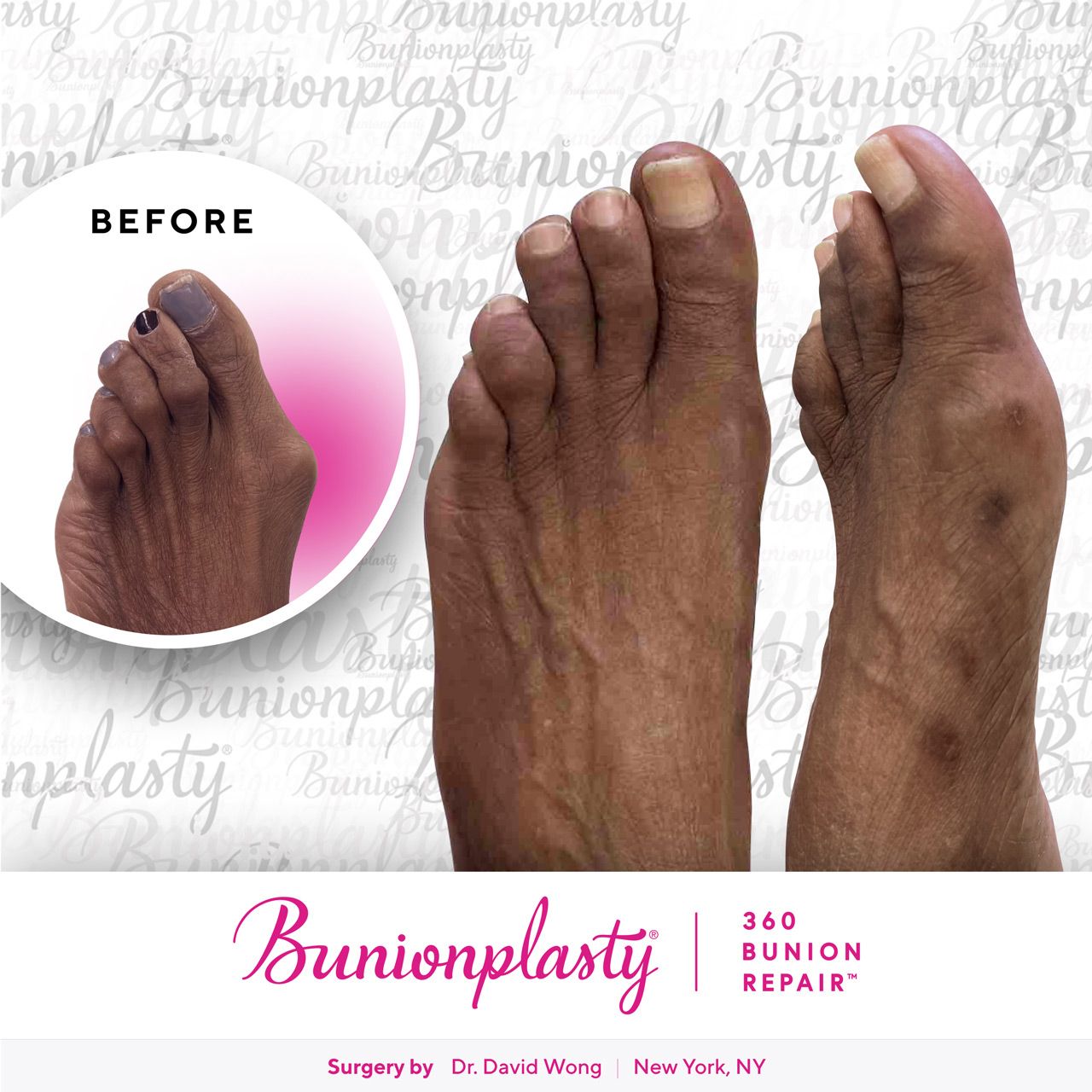 Bunionplasty® Before & After |  Dr. David Wong  |  Severe Bunion  |  Left Foot