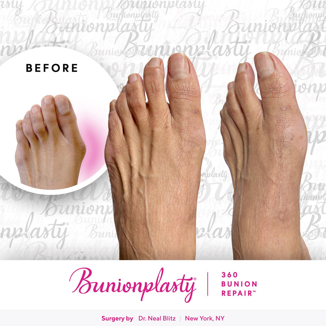 Bunionplasty® Before & After |  Large Bunion  |  Left Foot