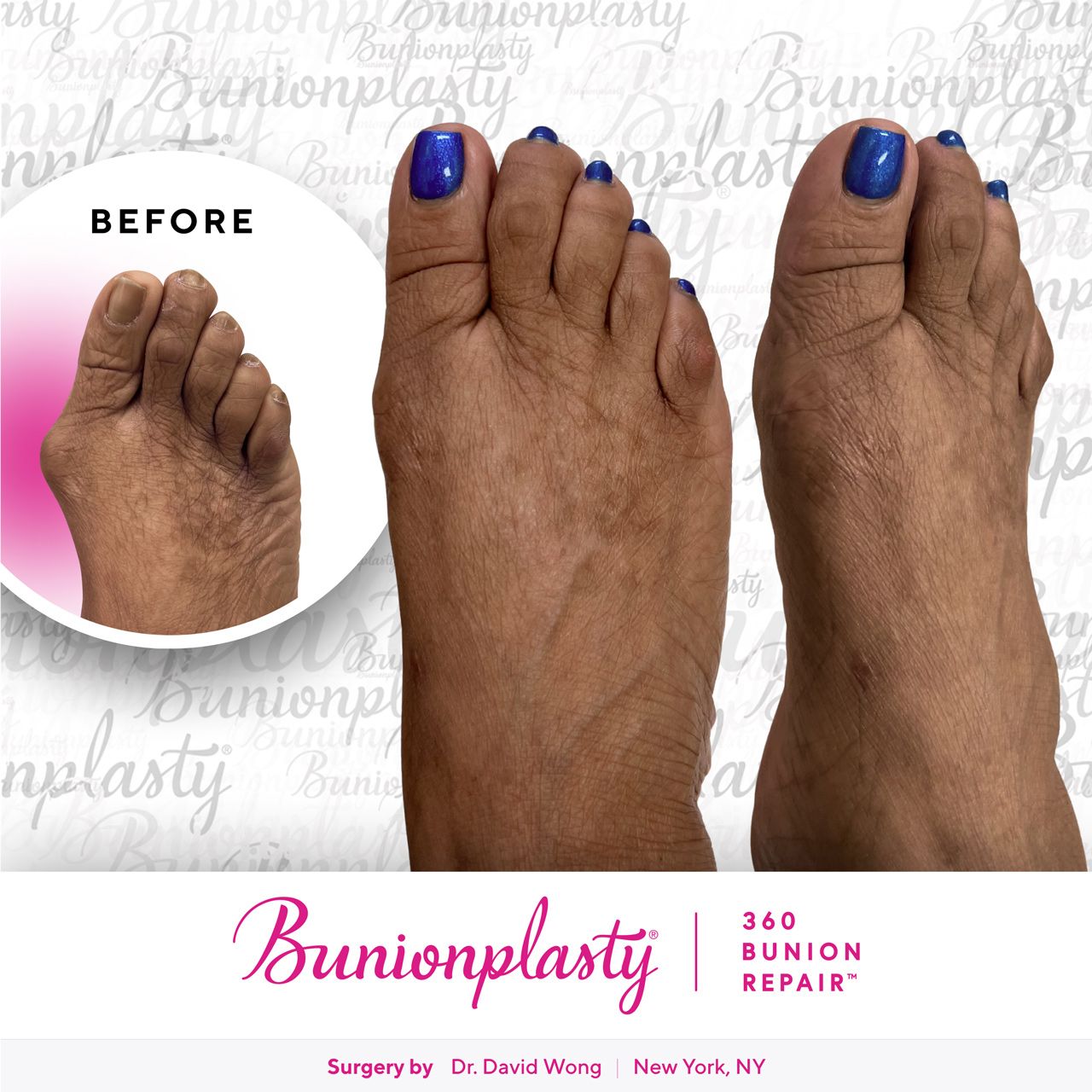 Bunionplasty® Before & After |  Dr. David Wong  |  Severe Bunion  |  Right Foot