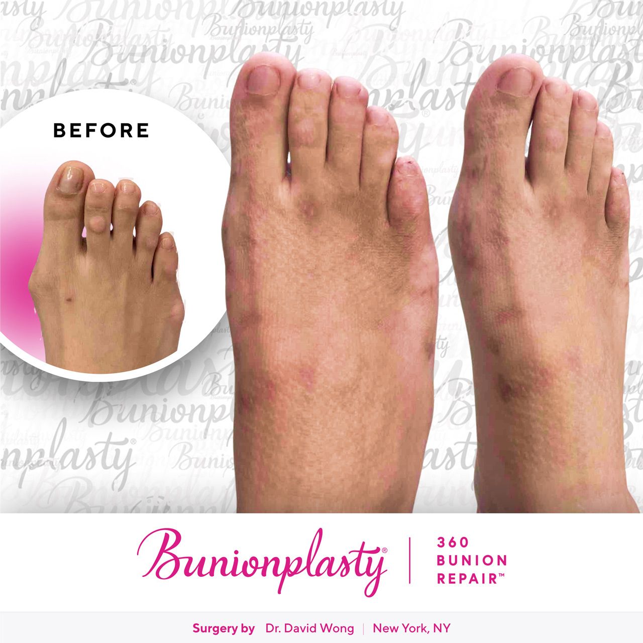 Bunionplasty® Before & After |  Dr. David Wong  |  Large Bunion  |  Right Foot