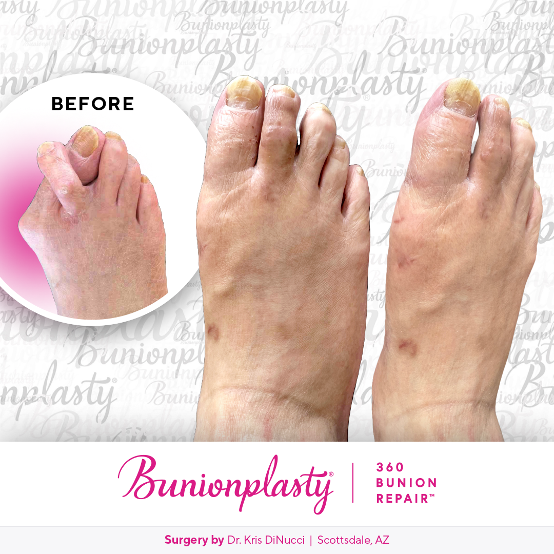 Bunionplasty® Before & After  |  Dr. Kris Di Nucci  |  Severe Bunion  |  Right Foot
