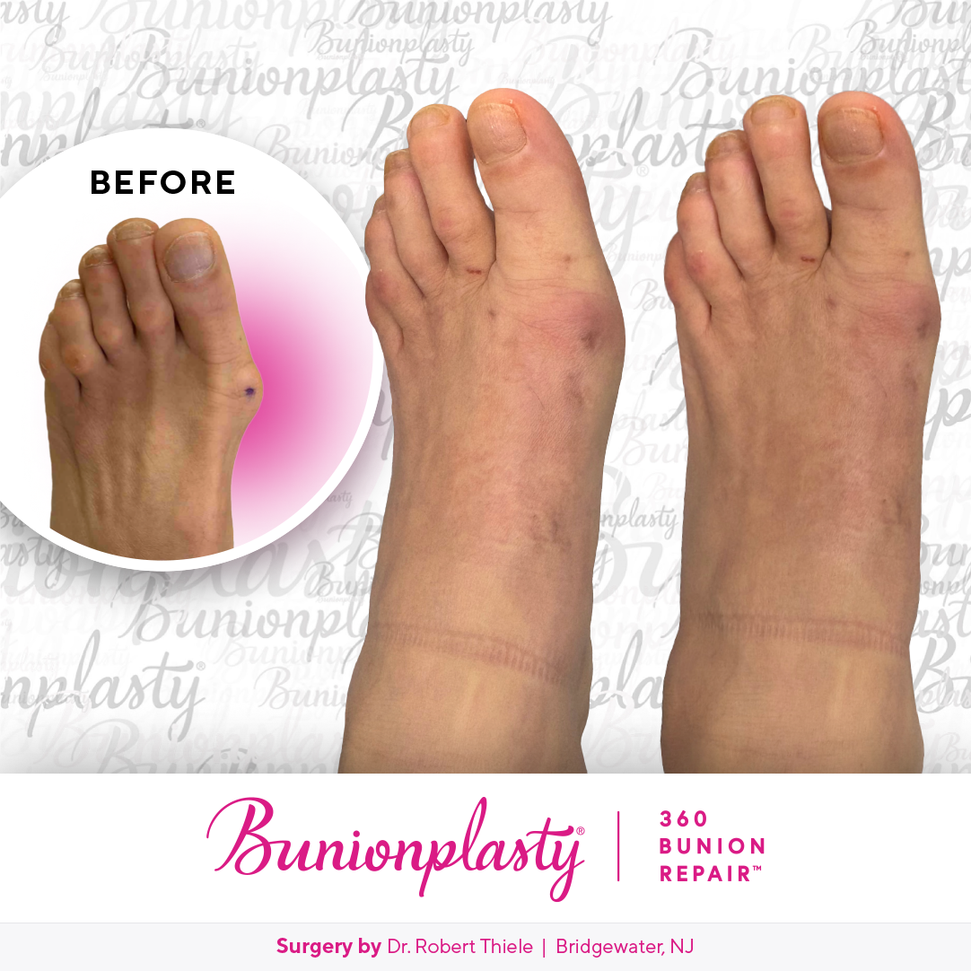 Bunionplasty® Before & After  |  Dr. Robert Thiele  |  Large Bunion  |  Left Foot