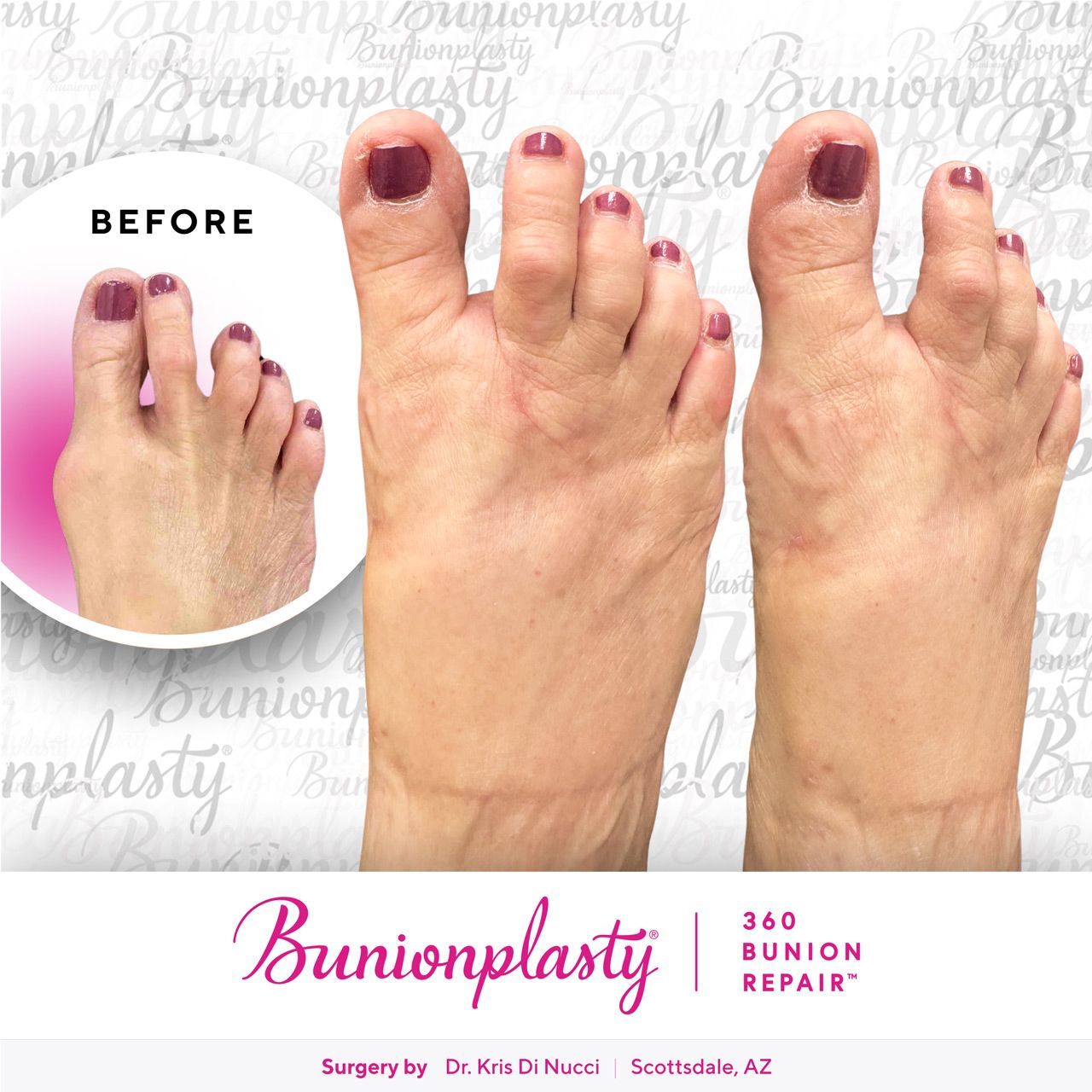 Bunionplasty® Before & After  |  Dr. Kris Di Nucci  |  Large Bunion  |  Right Foot