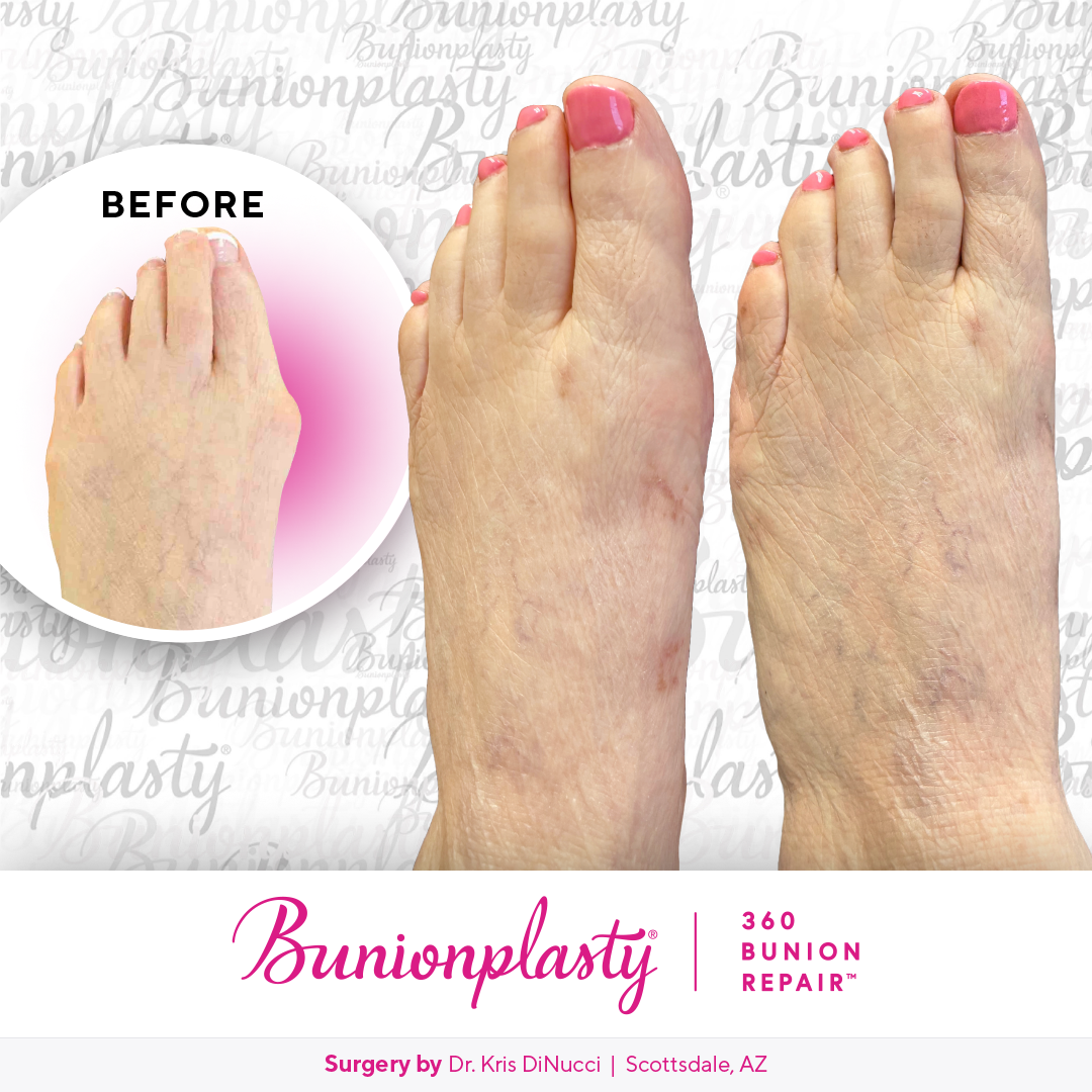 Bunionplasty® Before & After  |  Dr. Kris Di Nucci  |  Severe Bunion  |  Left Foot