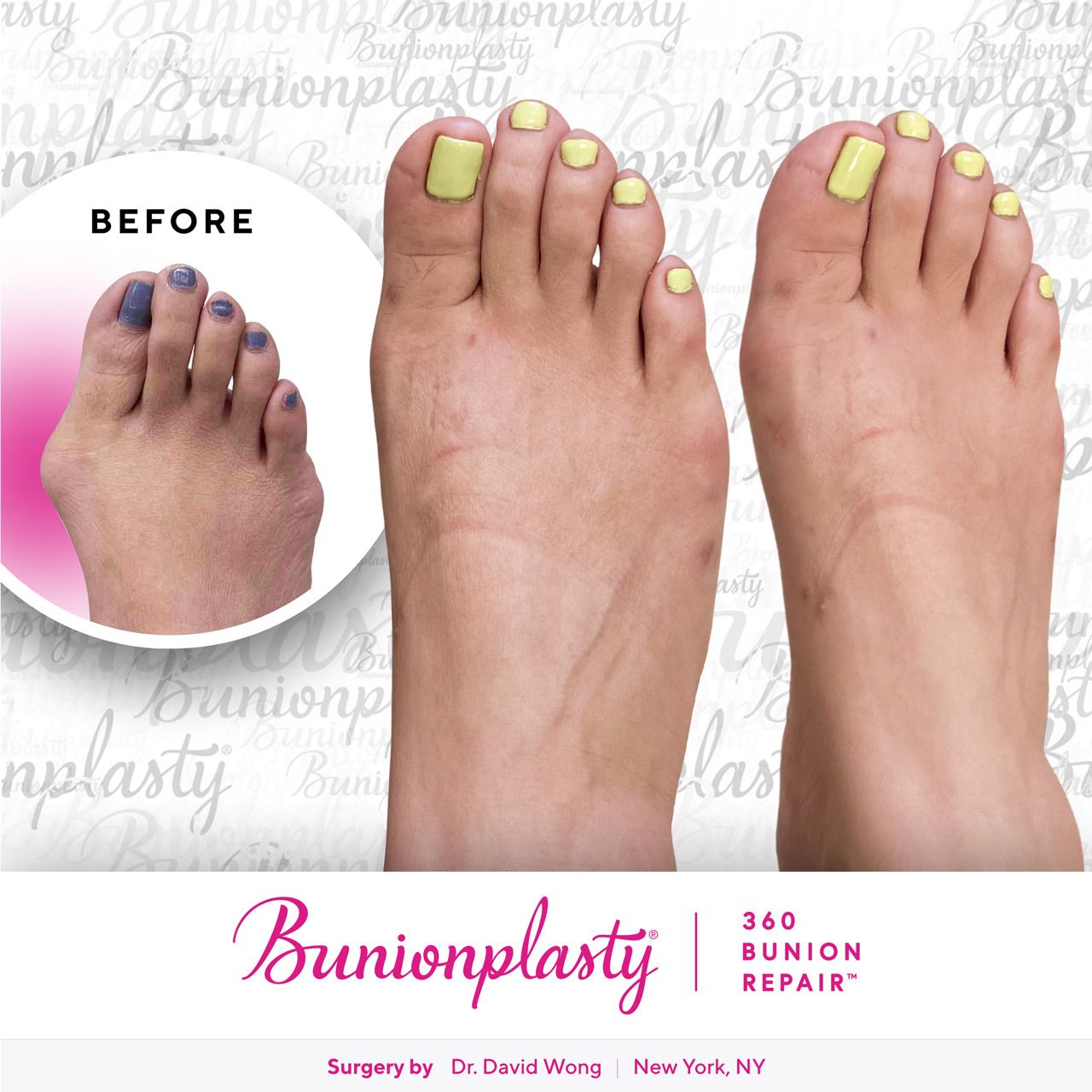 Bunionplasty® Before & After |  Dr. David Wong  |  Severe Bunion  |  Right Foot