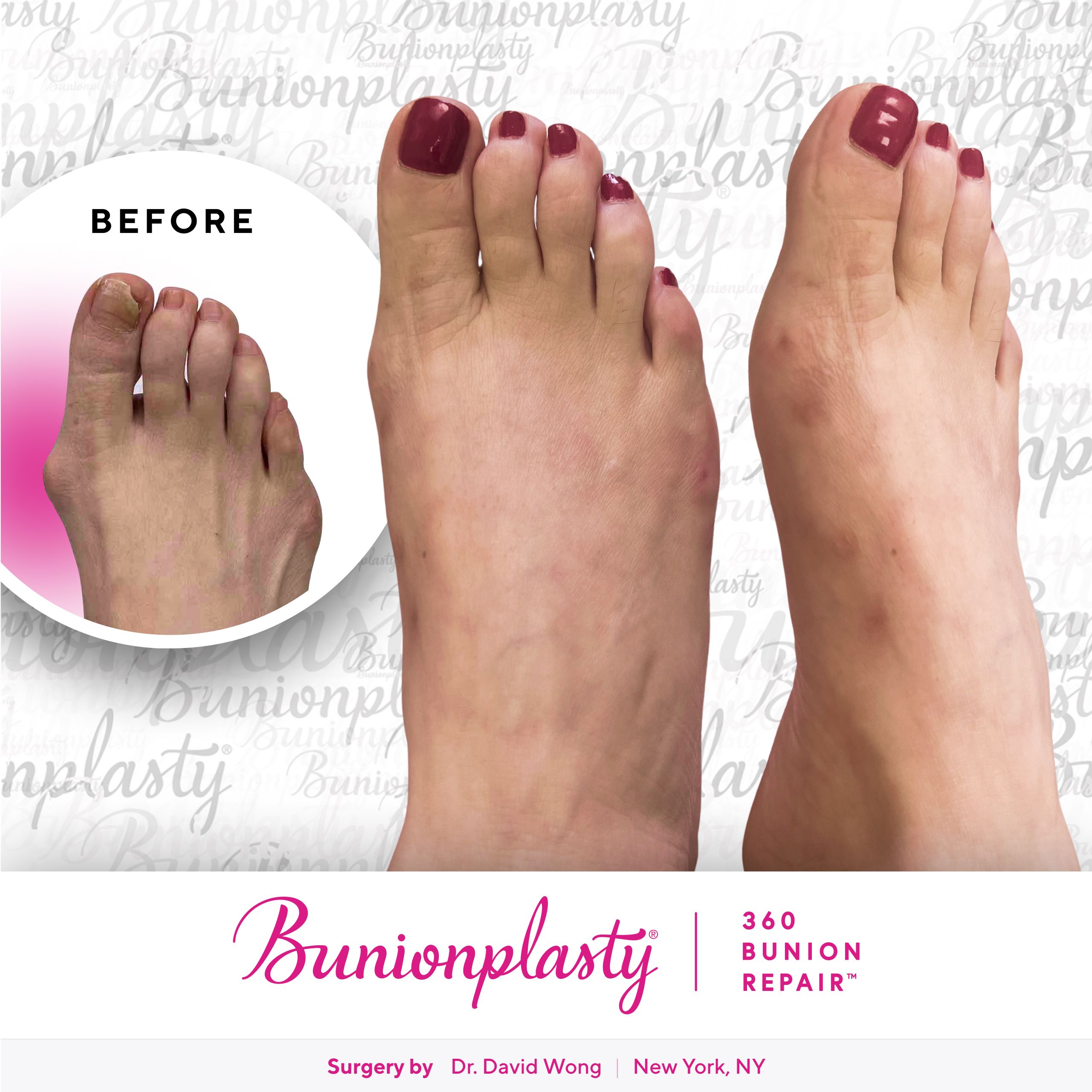 Bunionplasty® Before & After |  Dr. David Wong  |  Large Bunion  |  Right Foot