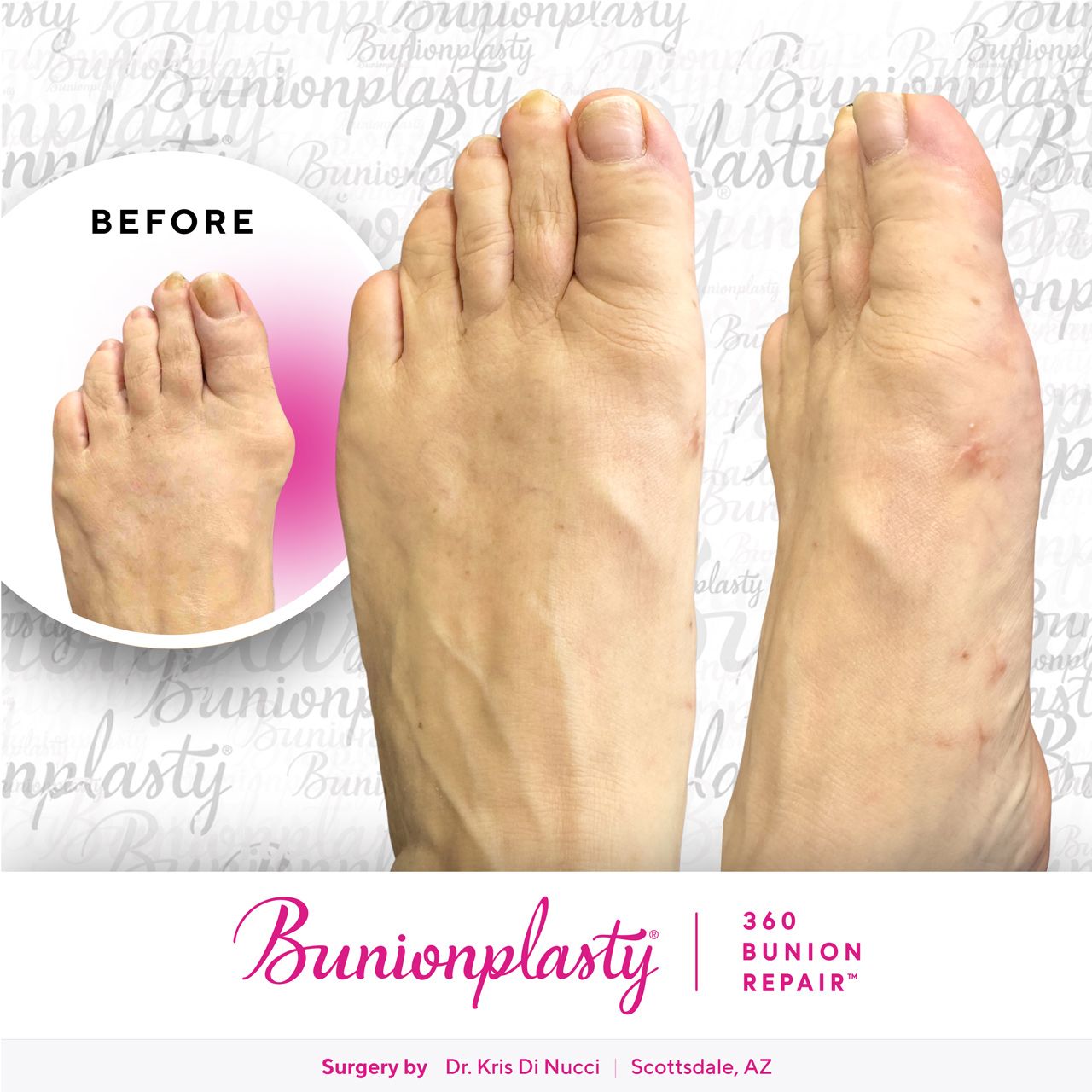 Bunionplasty® Before & After  |  Dr. Kris Di Nucci  |  Mild Bunion  |  Left Foot