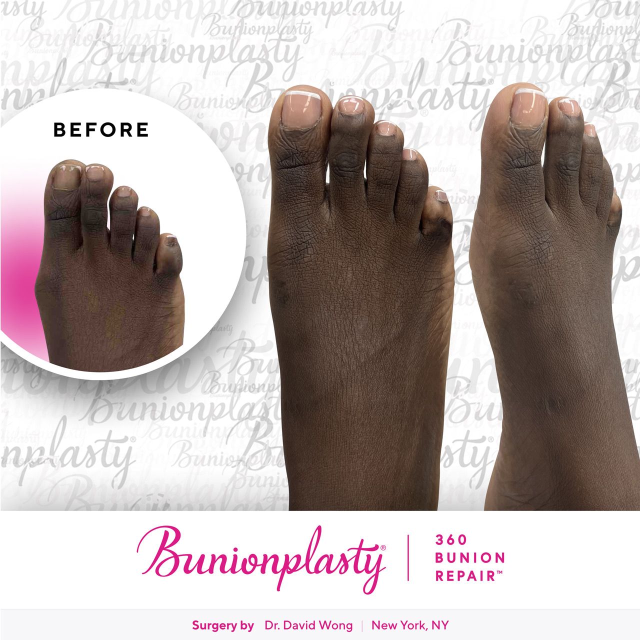 Bunionplasty® Before & After |  Dr. David Wong  |  Mild Bunion  |  Right Foot