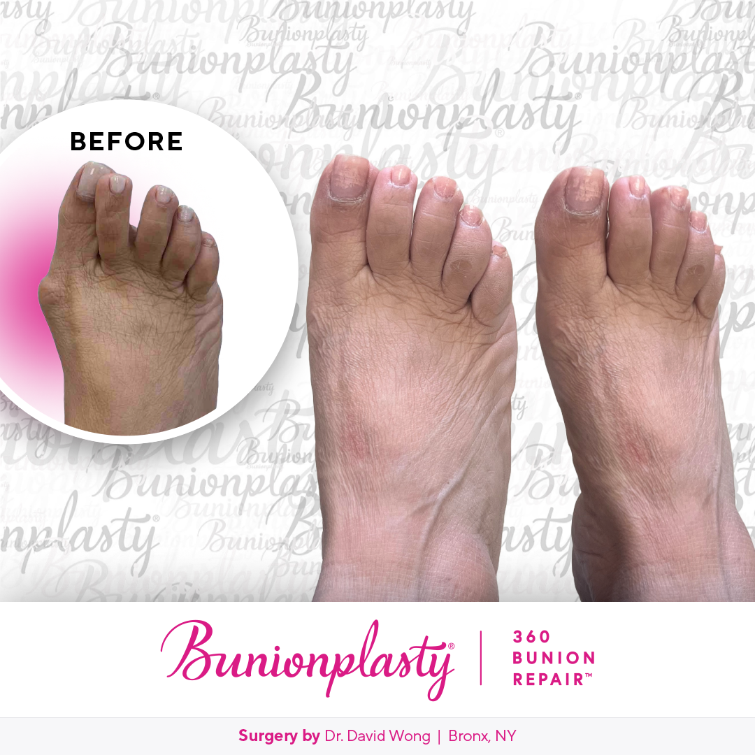 Bunionplasty® Before & After  |  Dr. David Wong |  Severe Bunion  |  Right Foot