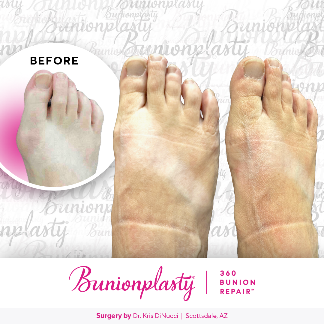 Bunionplasty® Before & After  |  Dr. Kris Di Nucci  |  Mild Bunion  |  Right Foot