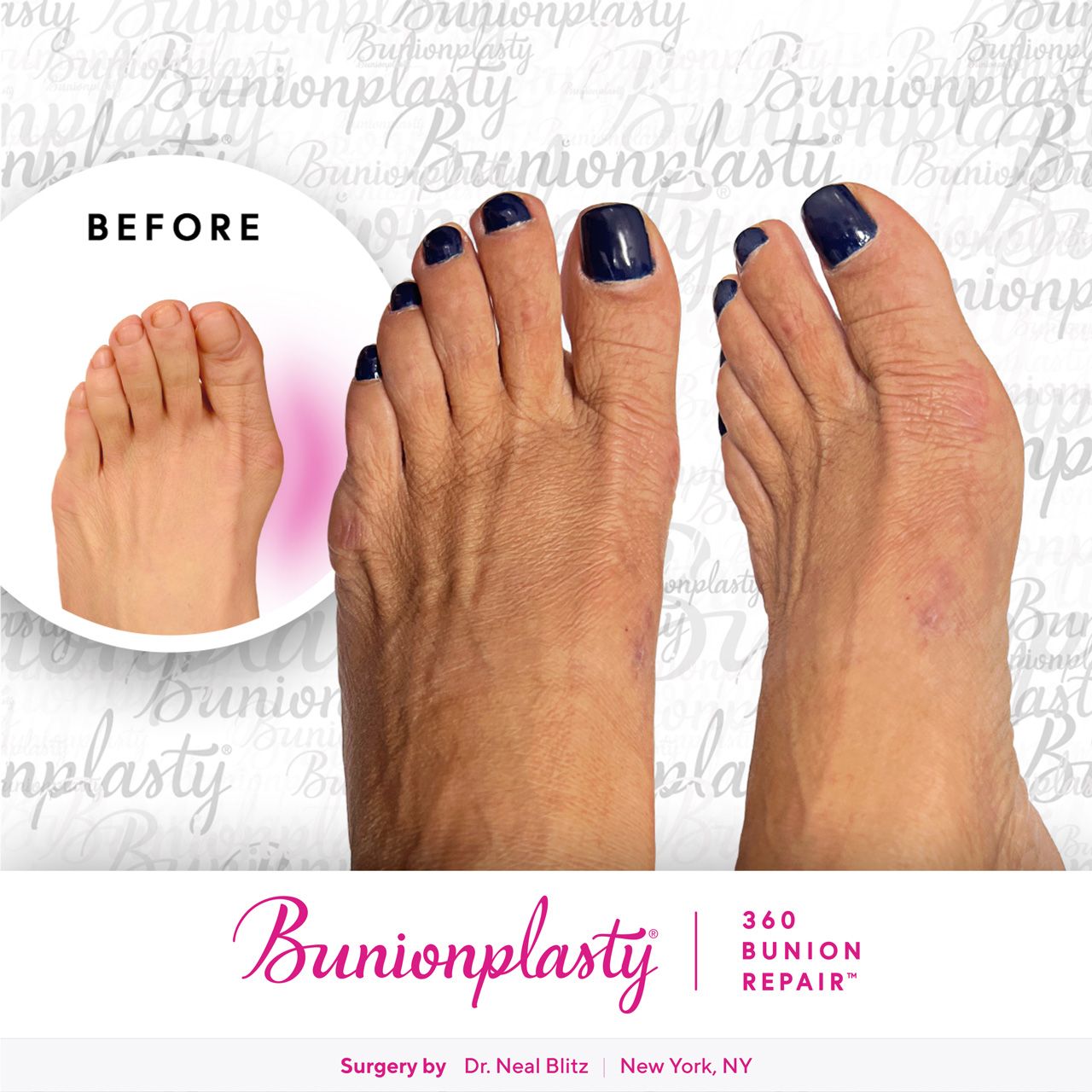 Bunionplasty® Before & After |  Large Bunion  |  Left Foot