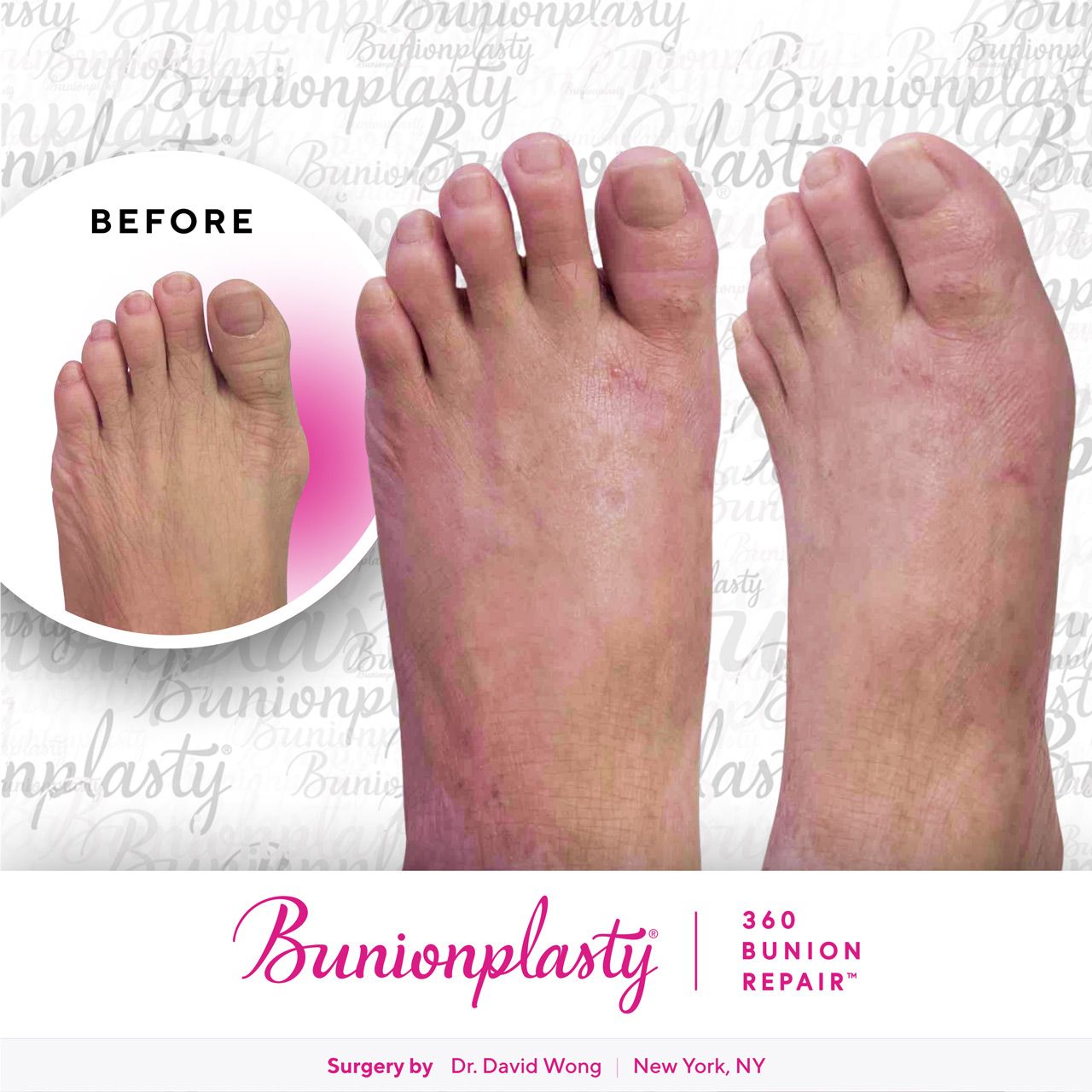 Bunionplasty® Before & After |  Mild Bunion  |  Left Foot