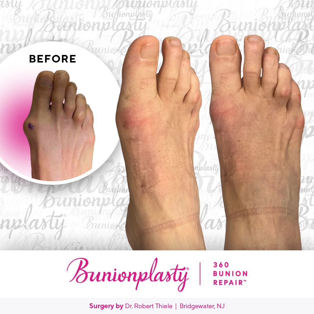 Bunionplasty® Before & After  |  Dr. Robert Thiele  |  Large Bunion  |  Right Foot