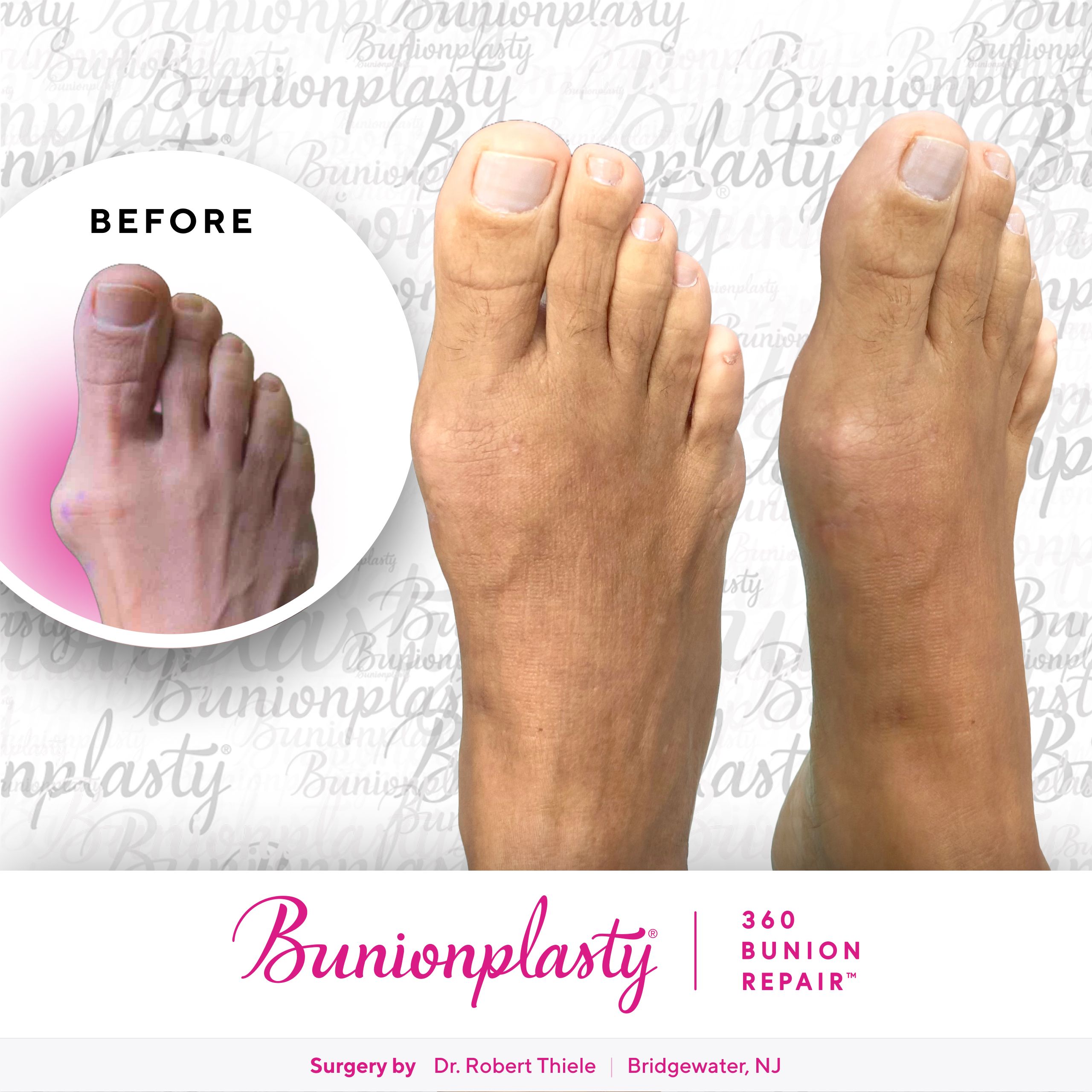 Bunionplasty® Before & After  |  Dr. Robert Thiele  |  Large Bunion  |  Right Foot