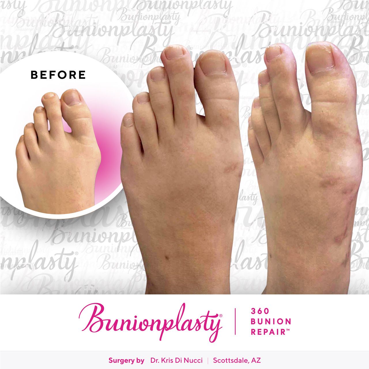 Bunionplasty® Before & After  |  Dr. Kris Di Nucci  |  Mild Bunion  |  Left Foot