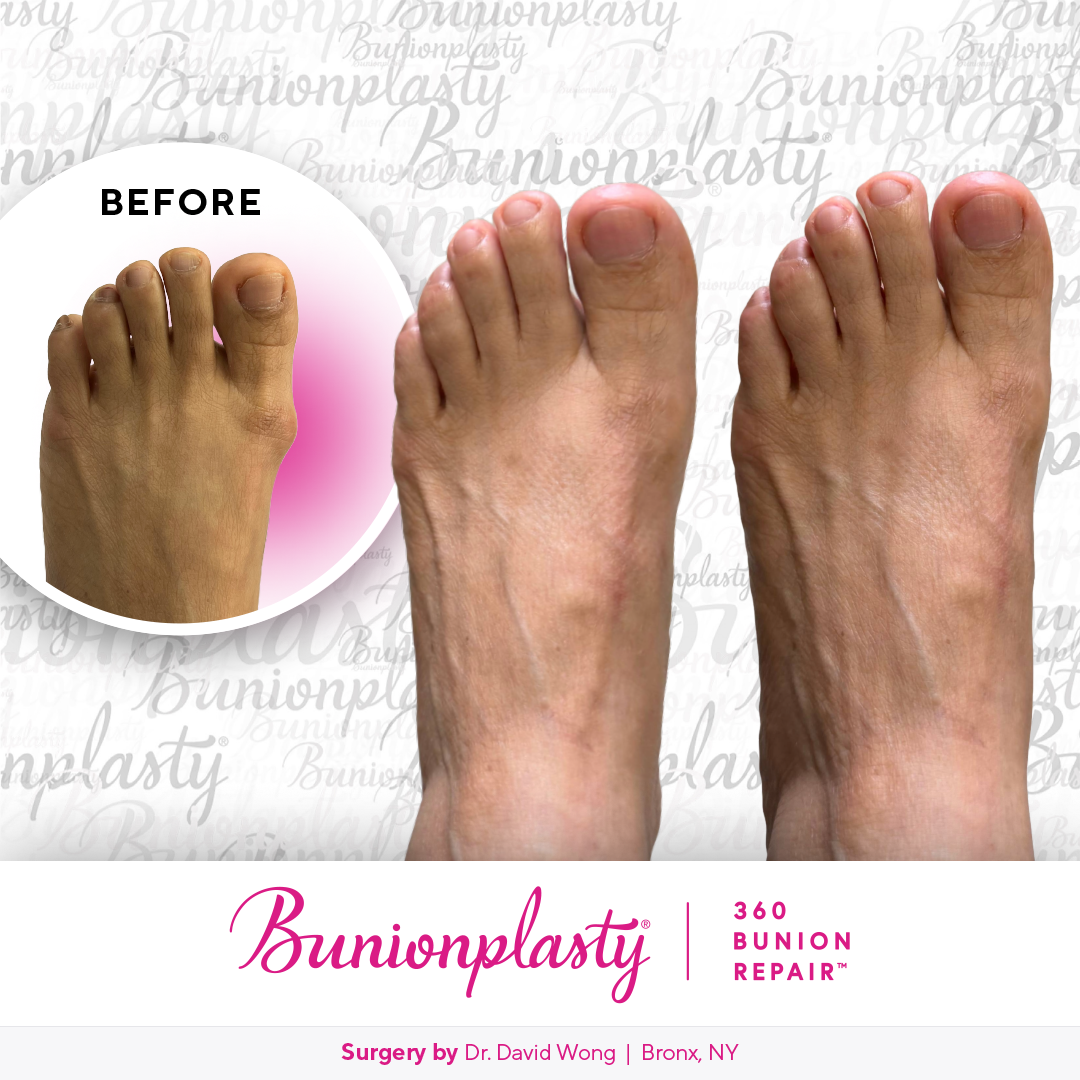 Bunionplasty® Before & After  |  Dr. David Wong |  Mild Bunion  |  Left Foot