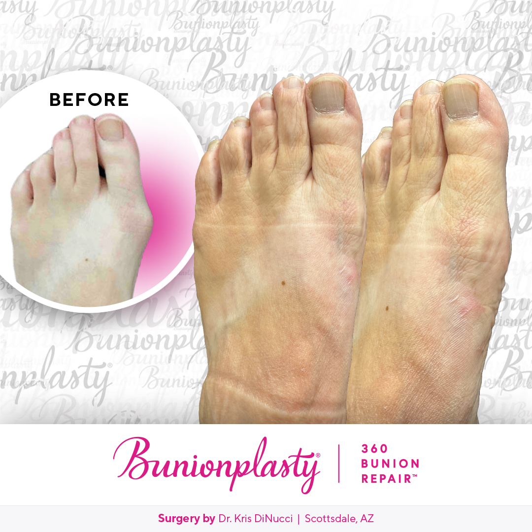 Bunionplasty® Before & After  |  Dr. Kris Di Nucci  |  Mild Bunion  |  Left Foot