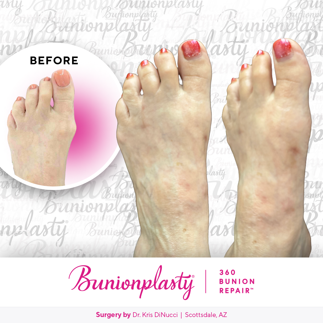 Bunionplasty® Before & After  |  Dr. Kris Di Nucci  |  Mild Bunion  |  Left Foot