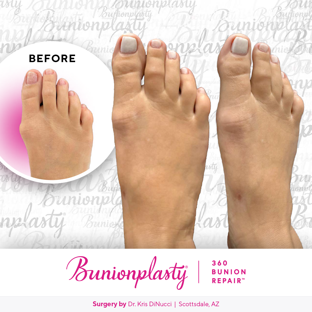 Bunionplasty® Before & After  |  Dr. Kris Di Nucci  |  Mild Bunion  |  Left Foot