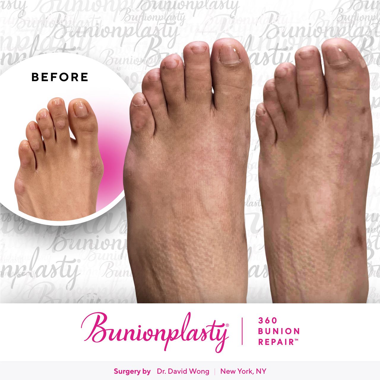 Bunionplasty® Before & After |  Dr. David Wong  |  Mild Bunion  |  Left Foot