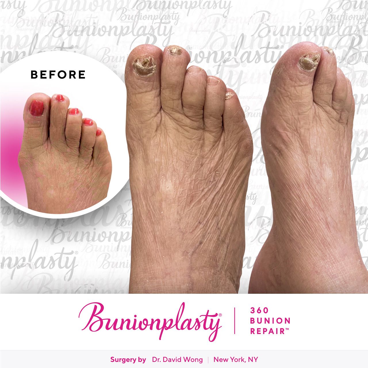 Bunionplasty® Before & After |  Dr. David Wong  |  Mild Bunion  |  Right Foot