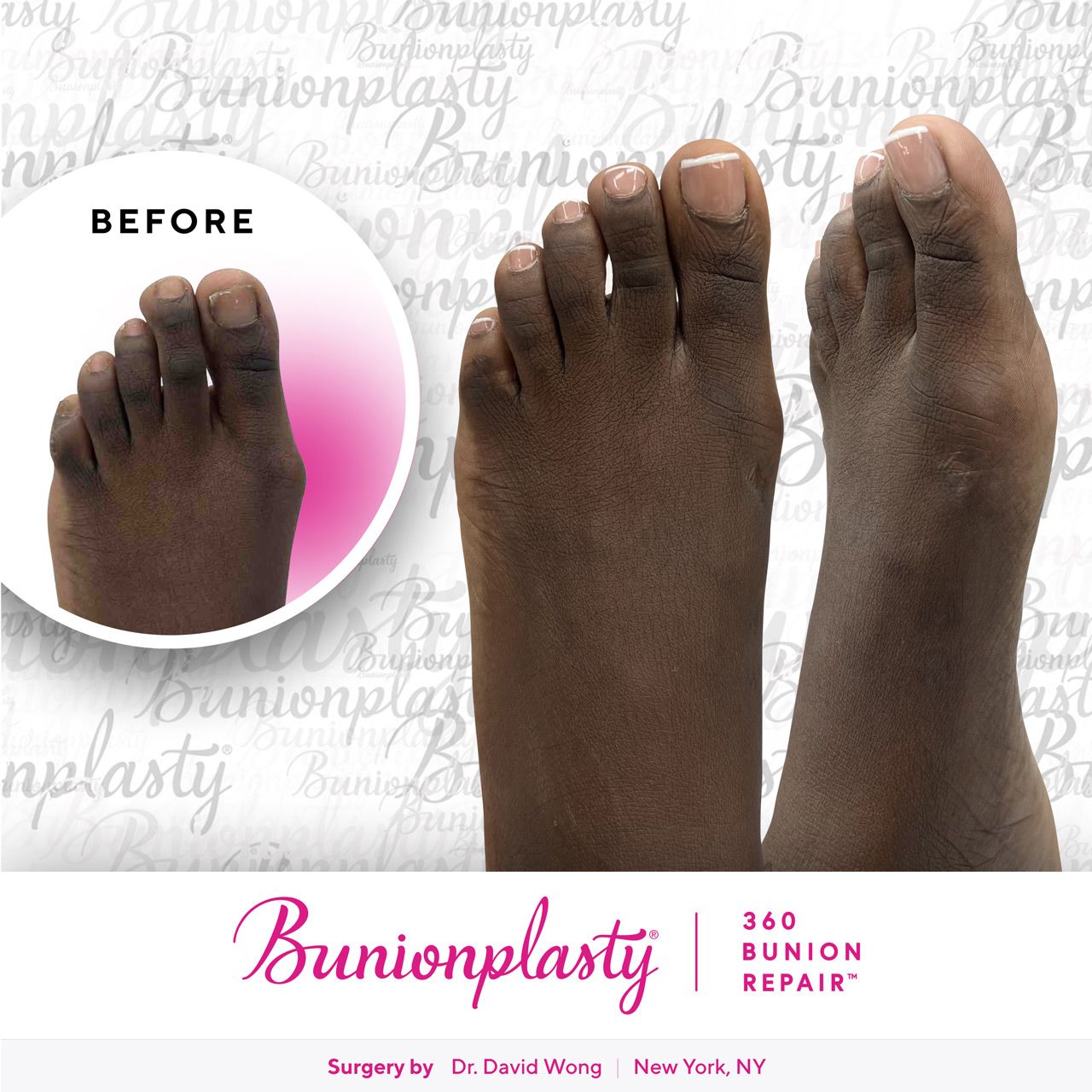 Bunionplasty® Before & After |  Dr. David Wong  |  Mild Bunion  |  Left Foot