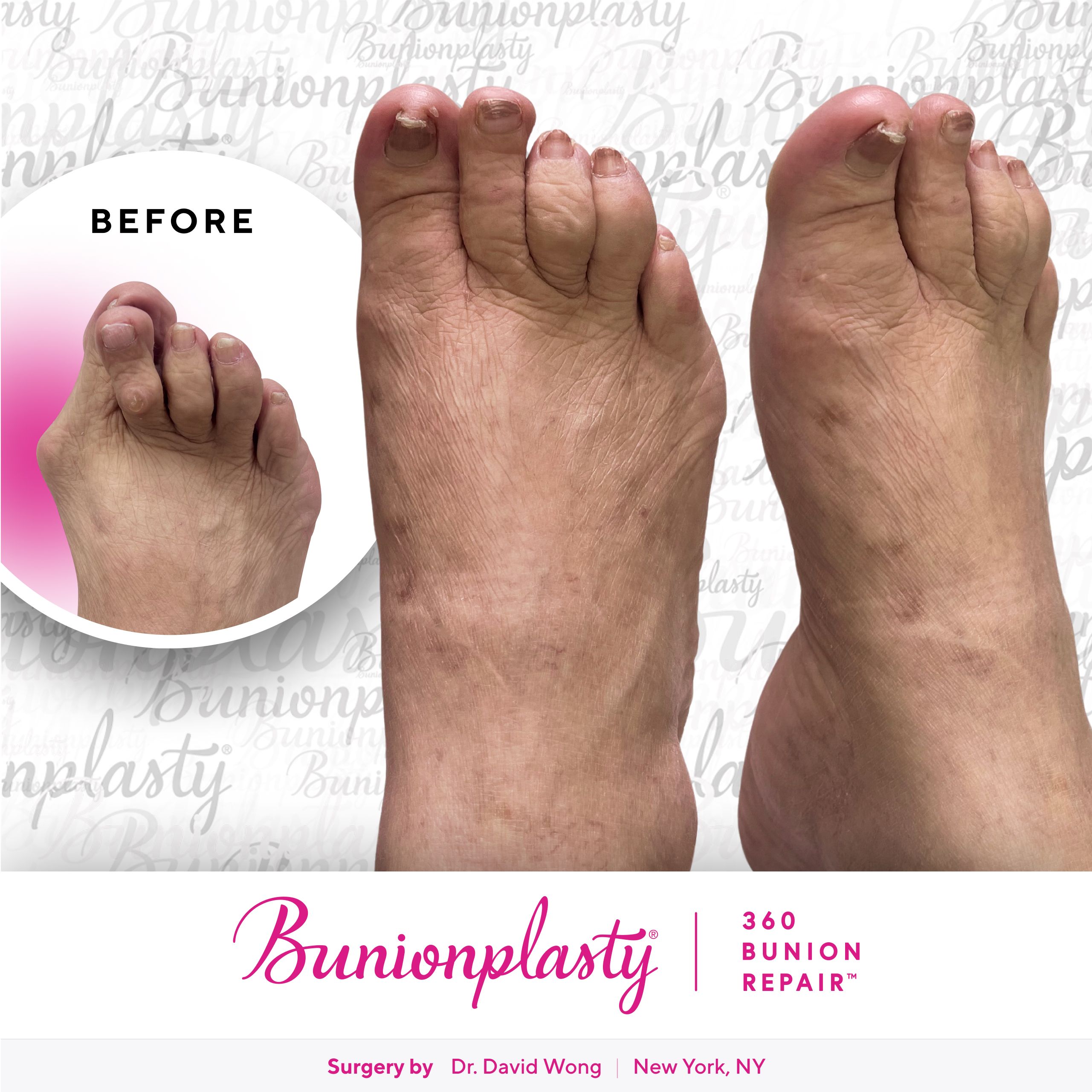 Bunionplasty® Before & After |  Dr. David Wong  |  Severe Bunion  |  Right Foot