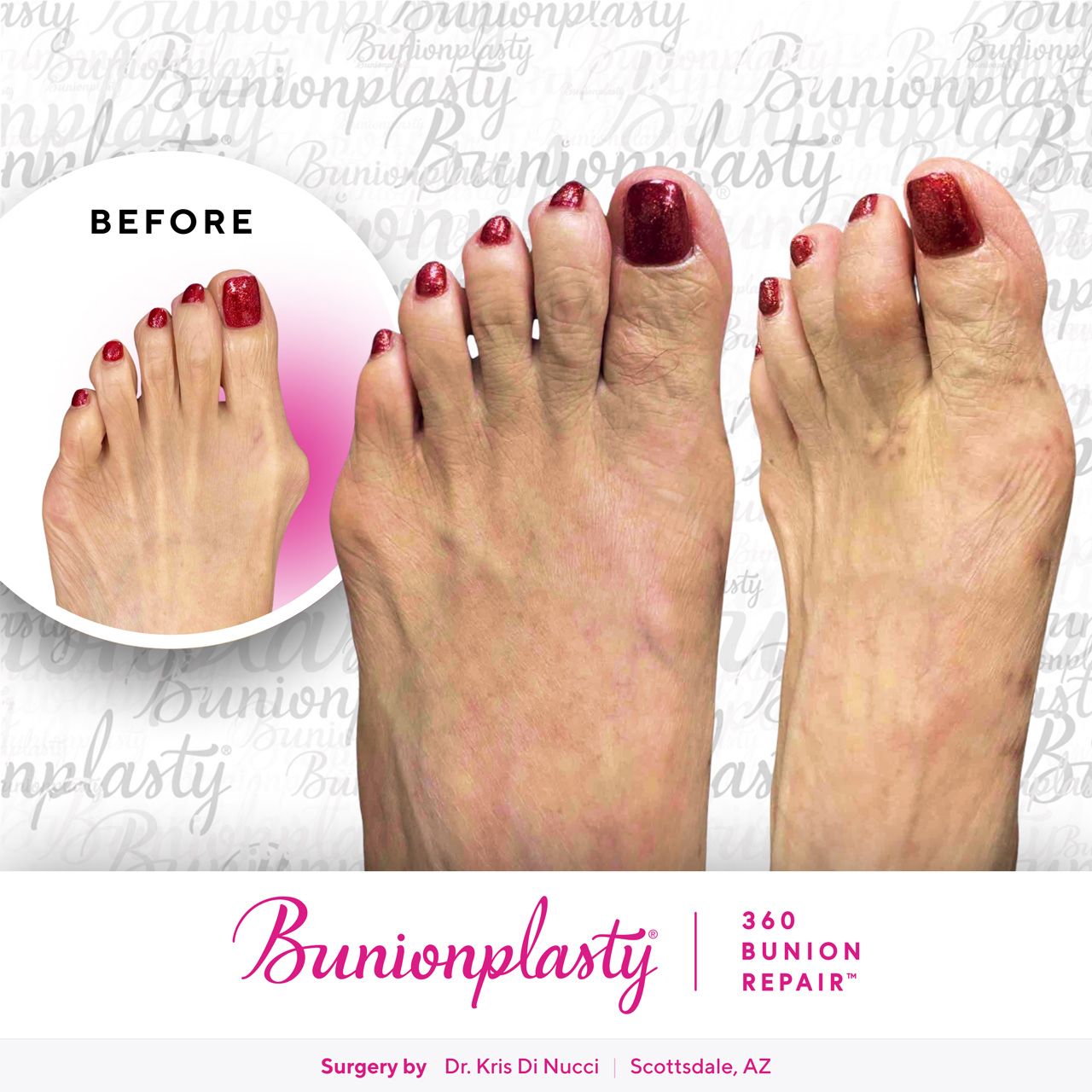 Bunionplasty® Before & After  |  Dr. Kris Di Nucci  |  Severe Bunion  |  Right Foot