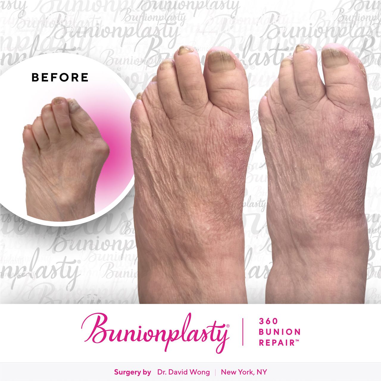 Bunionplasty® Before & After |  Severe Bunion  |  Left Foot