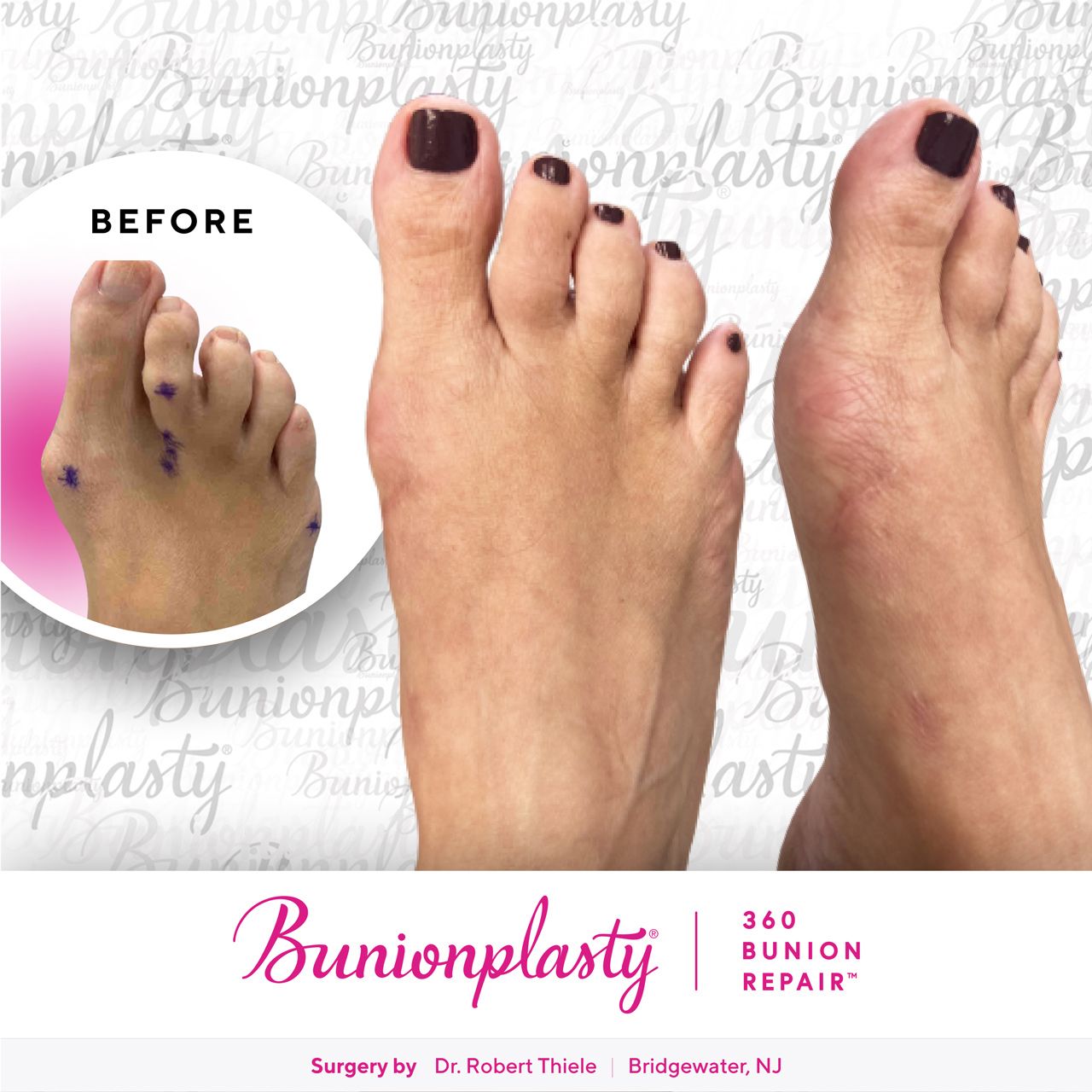 Bunionplasty® Before & After  |  Dr. Robert Thiele  |  Large Bunion  |  Right Foot