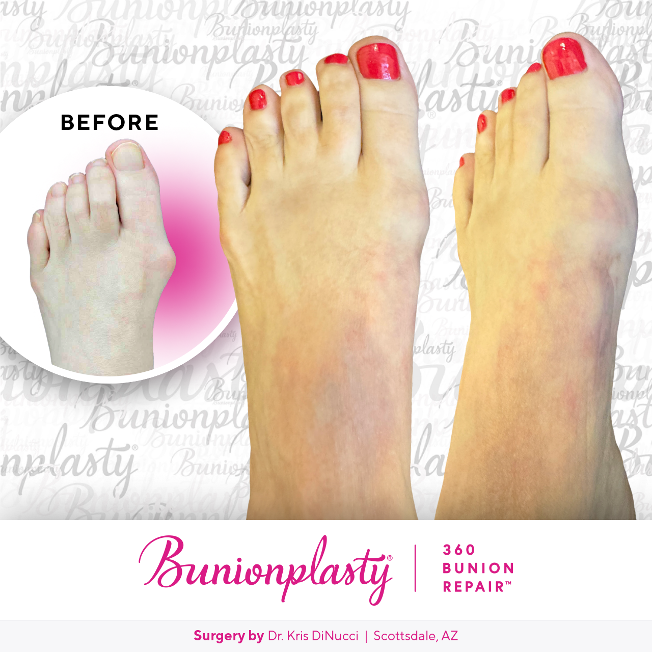 Bunionplasty® Before & After  |  Dr. Kris Di Nucci  |  Mild Bunion  |  Right Foot