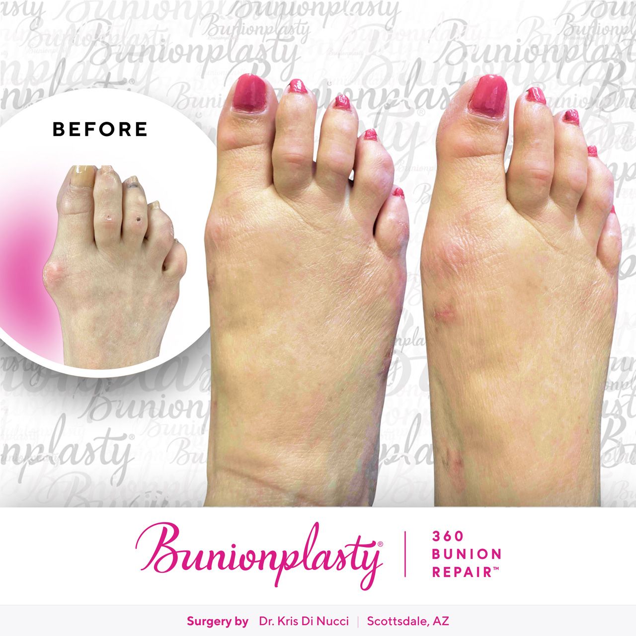 Bunionplasty® Before & After  |  Dr. Kris Di Nucci  |  Large Bunion  |  Right Foot