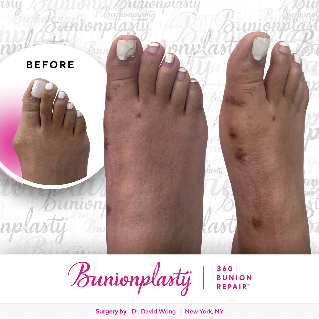 Bunionplasty® Before & After |  Large Bunion  |  Right Foot