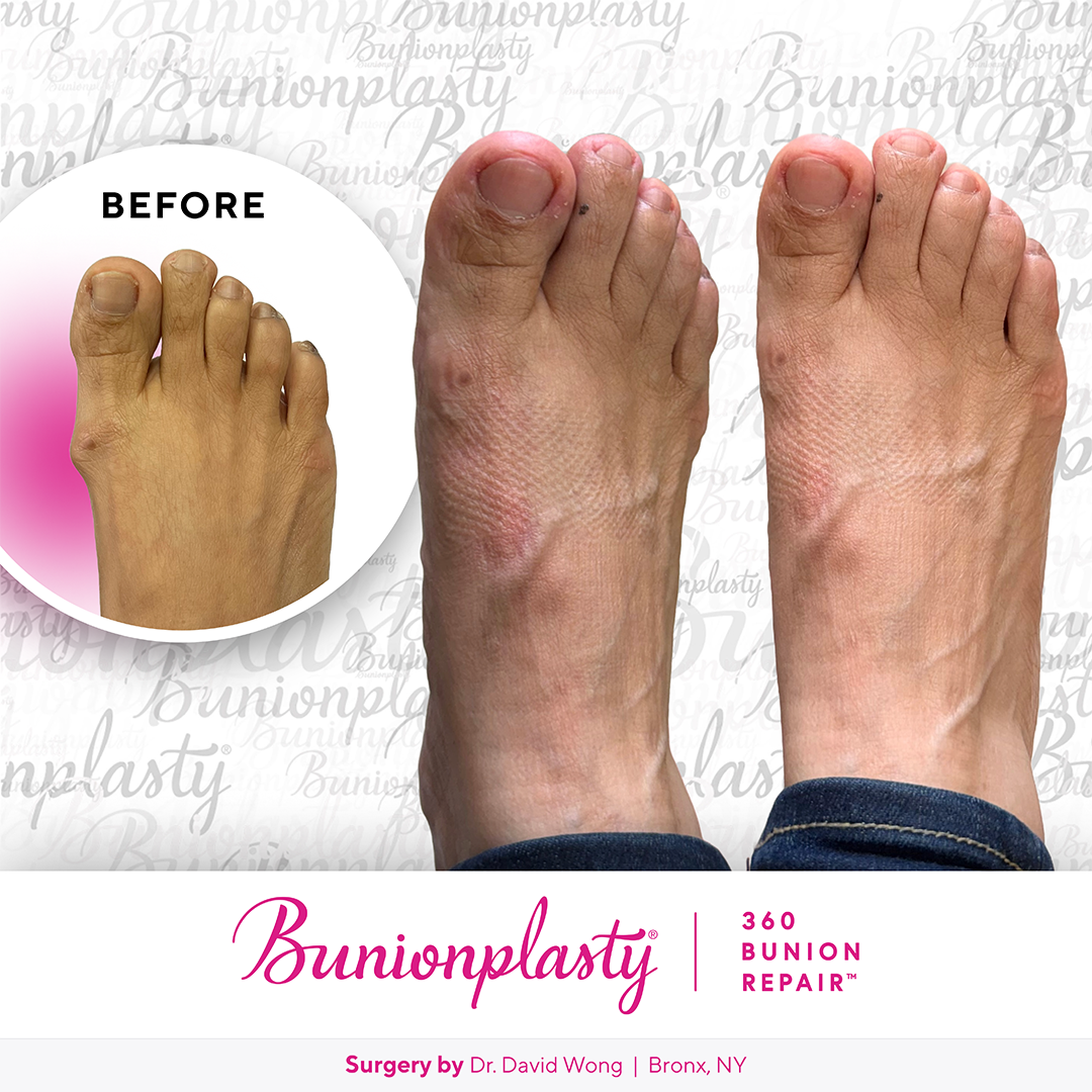 Bunionplasty® Before & After  |  Dr. David Wong |  Mild Bunion  |  Right Foot