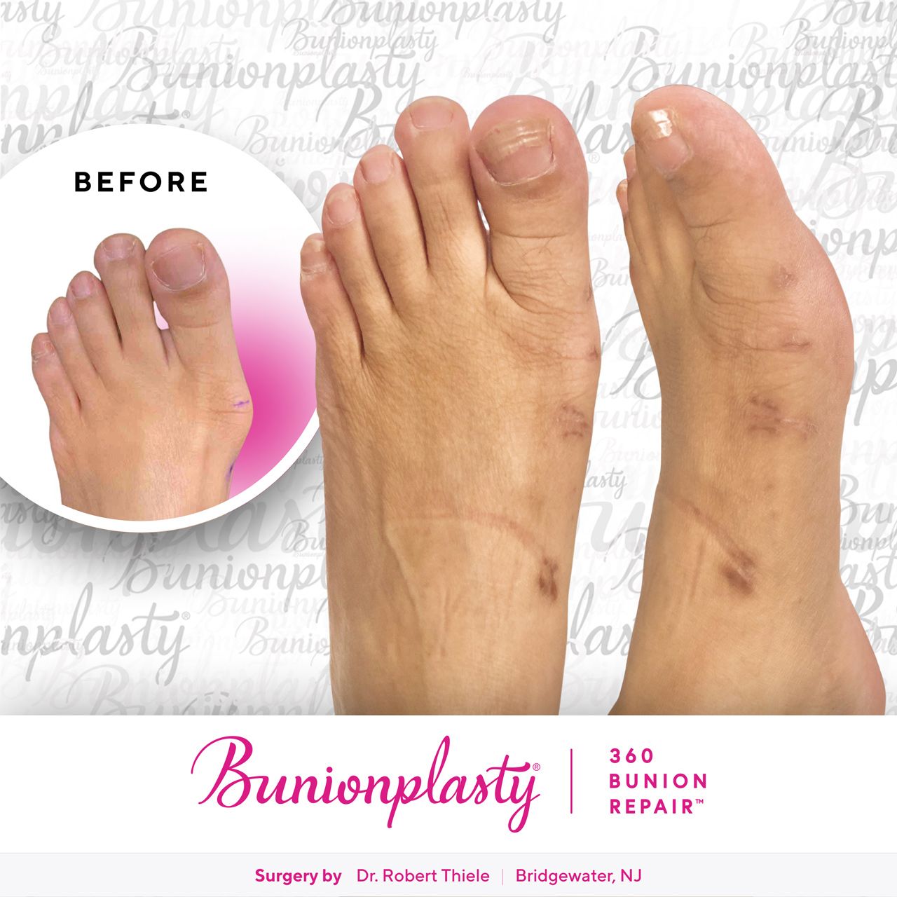 Bunionplasty® Before & After  |  Dr. Robert Thiele  |  Large Bunion  |  Left Foot