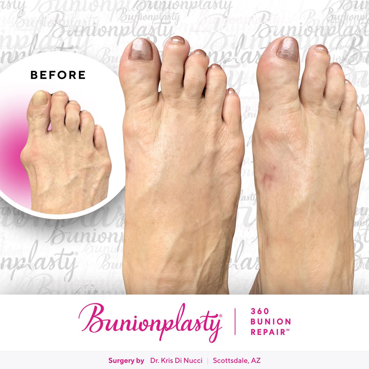 Bunionplasty® Before & After  |  Dr. Kris Di Nucci  |  Large Bunion  |  Right Foot