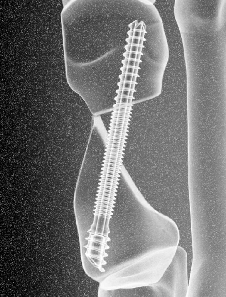 Groundbreaking Advancement in Minimally Invasive Bunion Surgery (MIBS)