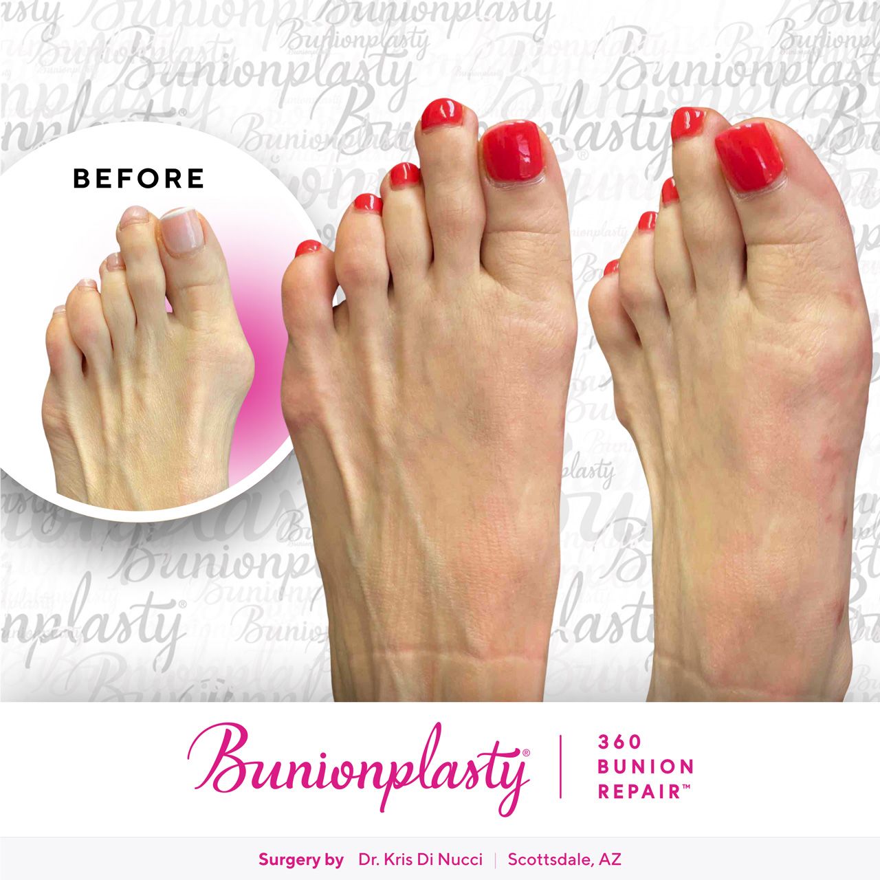 Bunionplasty® Before & After  |  Dr. Kris Di Nucci  |  Large Bunion  |  Left Foot