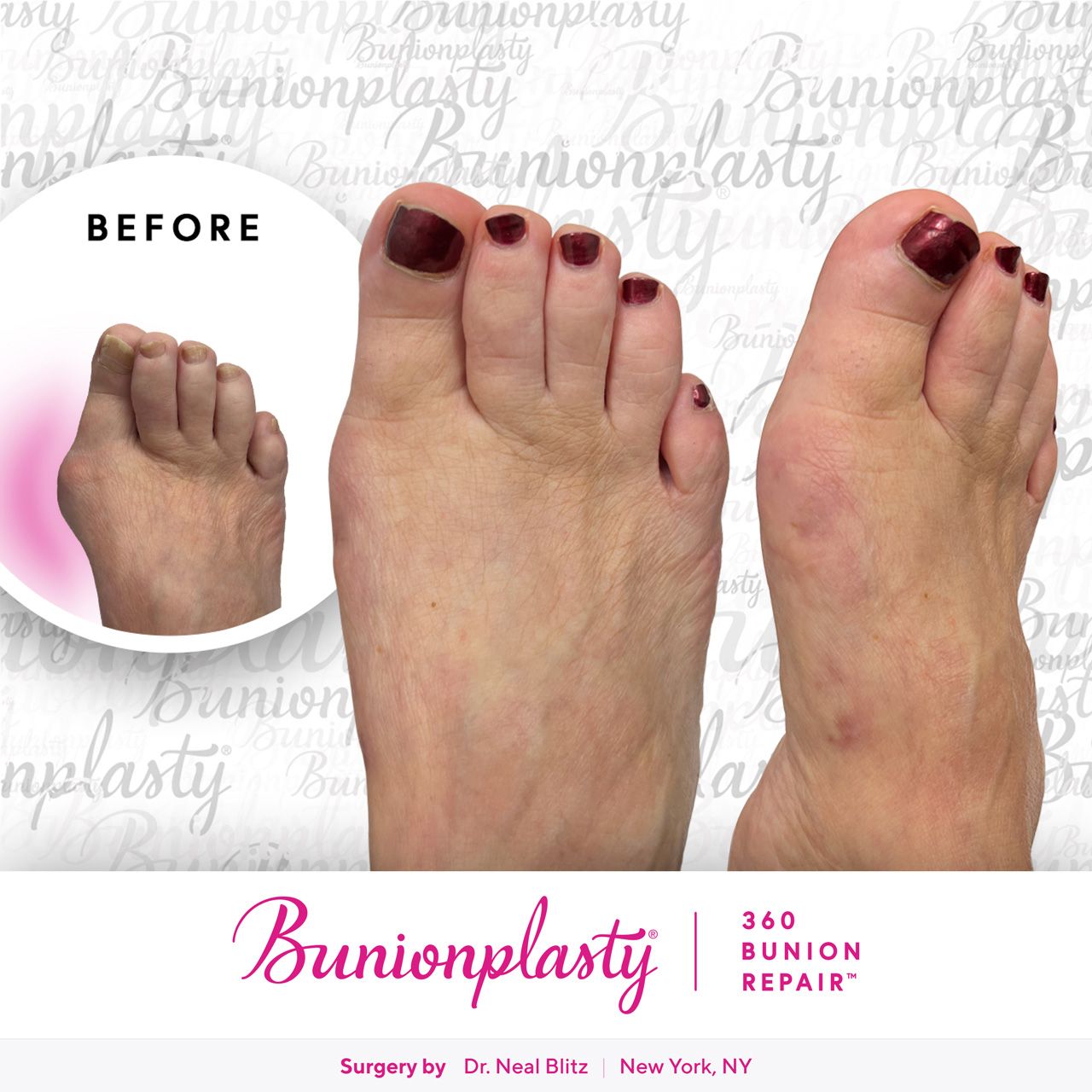 Bunionplasty® Before & After |  Severe Bunion  |  Right Foot