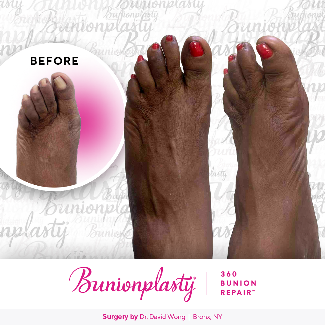 Bunionplasty® Before & After  |  Dr. David Wong |  Large Bunion  |  Left Foot