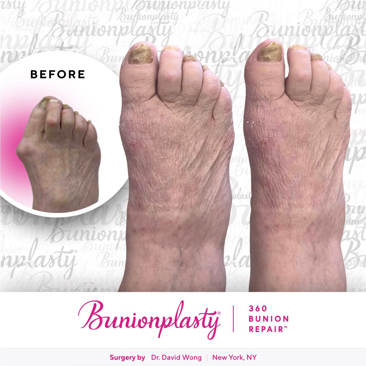 Bunionplasty® Before & After |  Severe Bunion  |  Right Foot